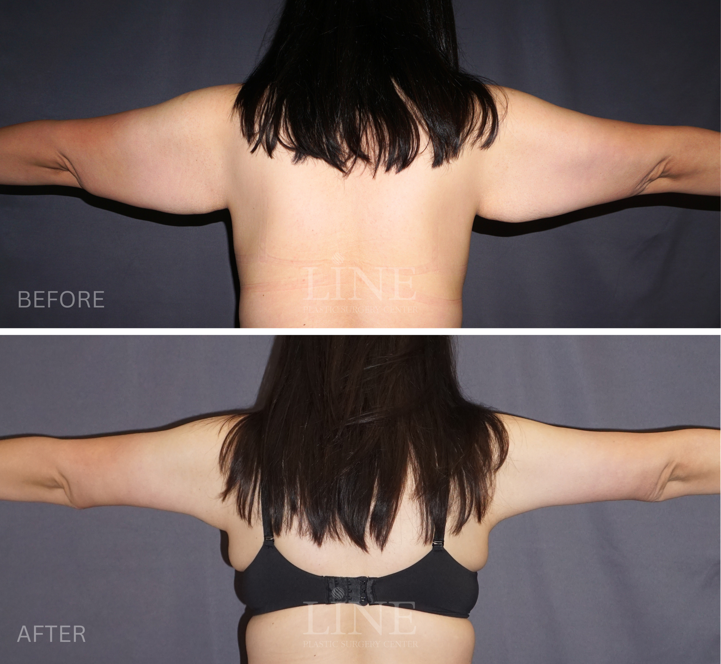 ARM LIFT (1)