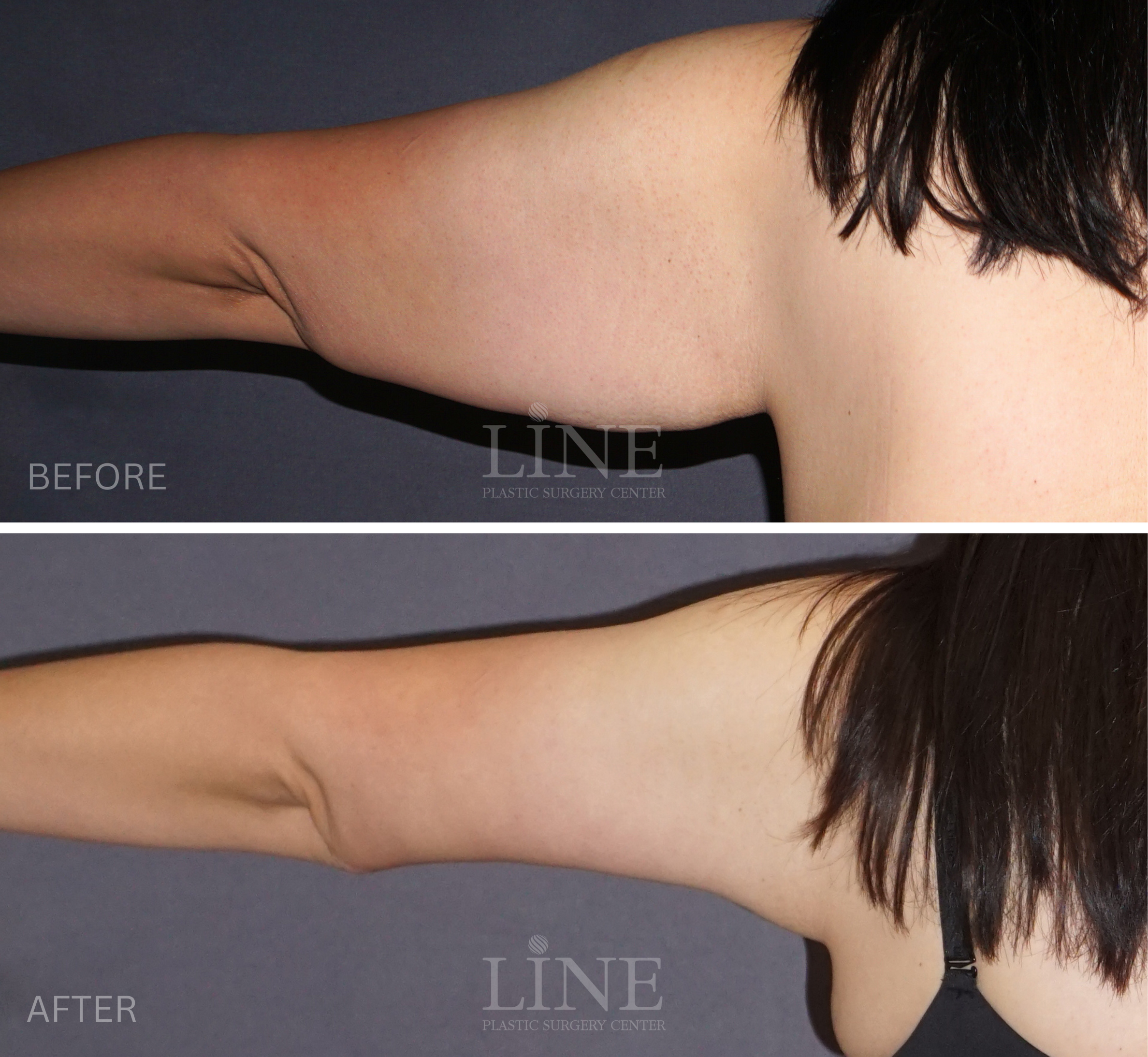 ARM LIFT (2)