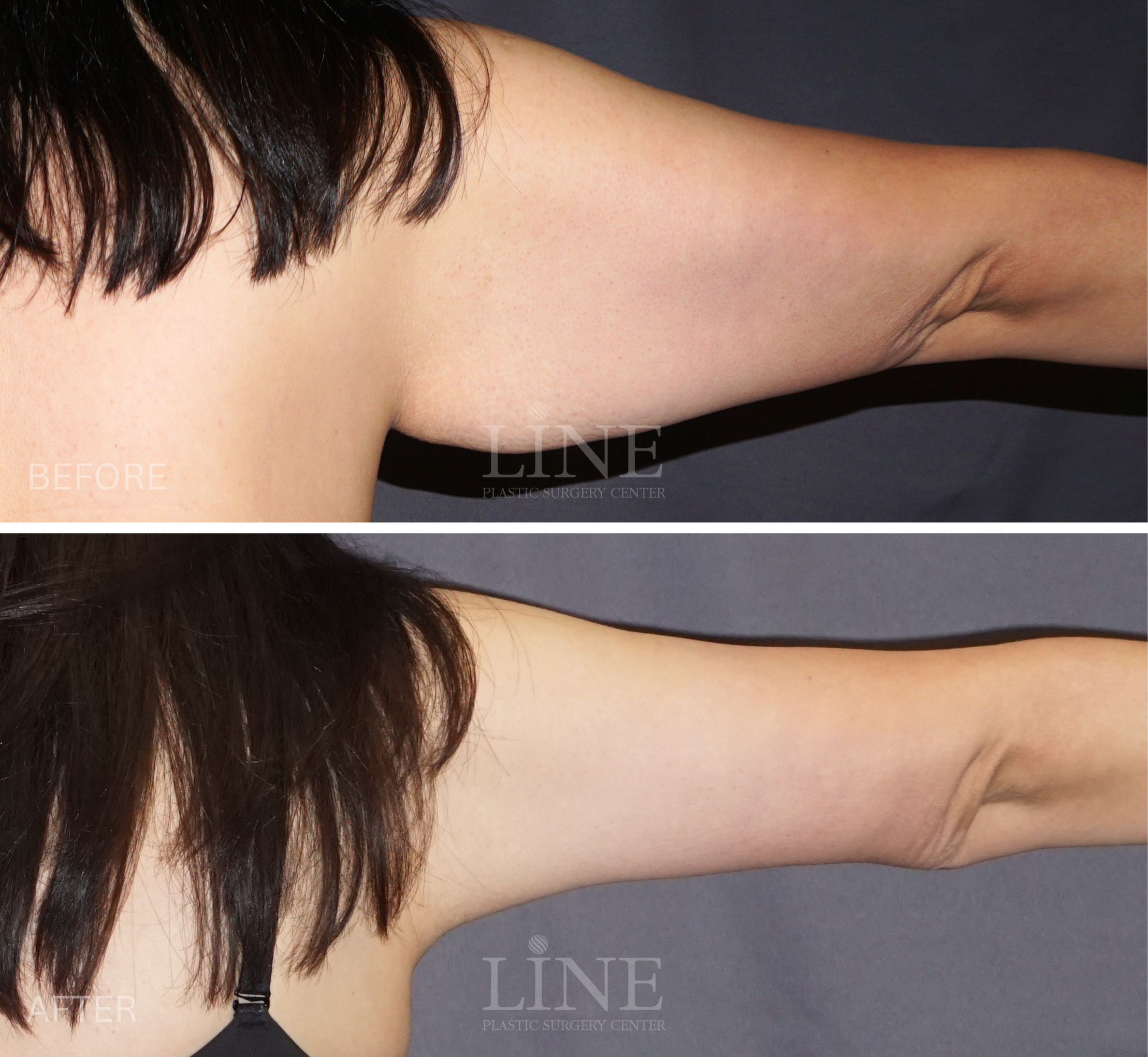 ARM LIFT (3)
