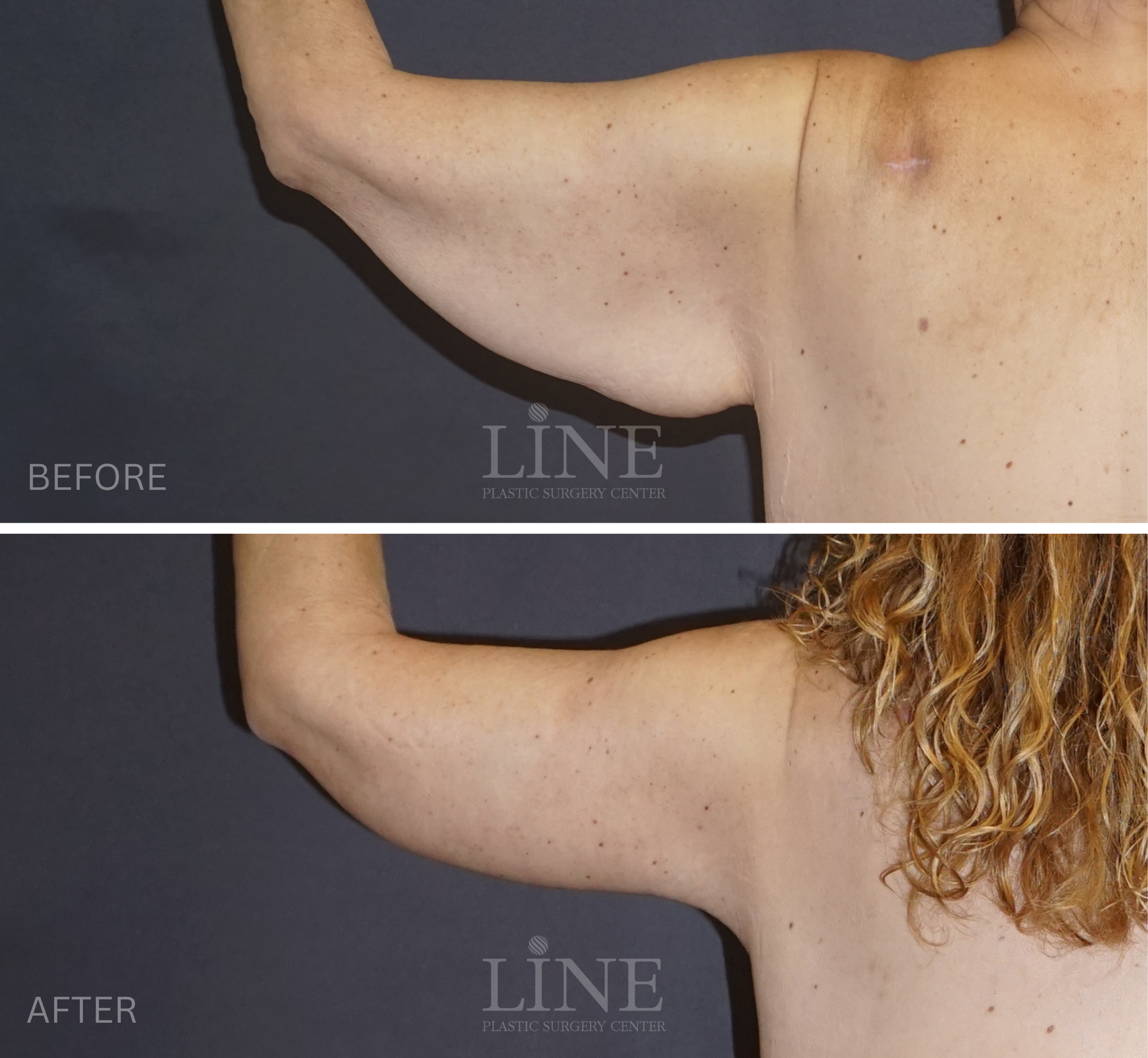 ARM LIFT (5)
