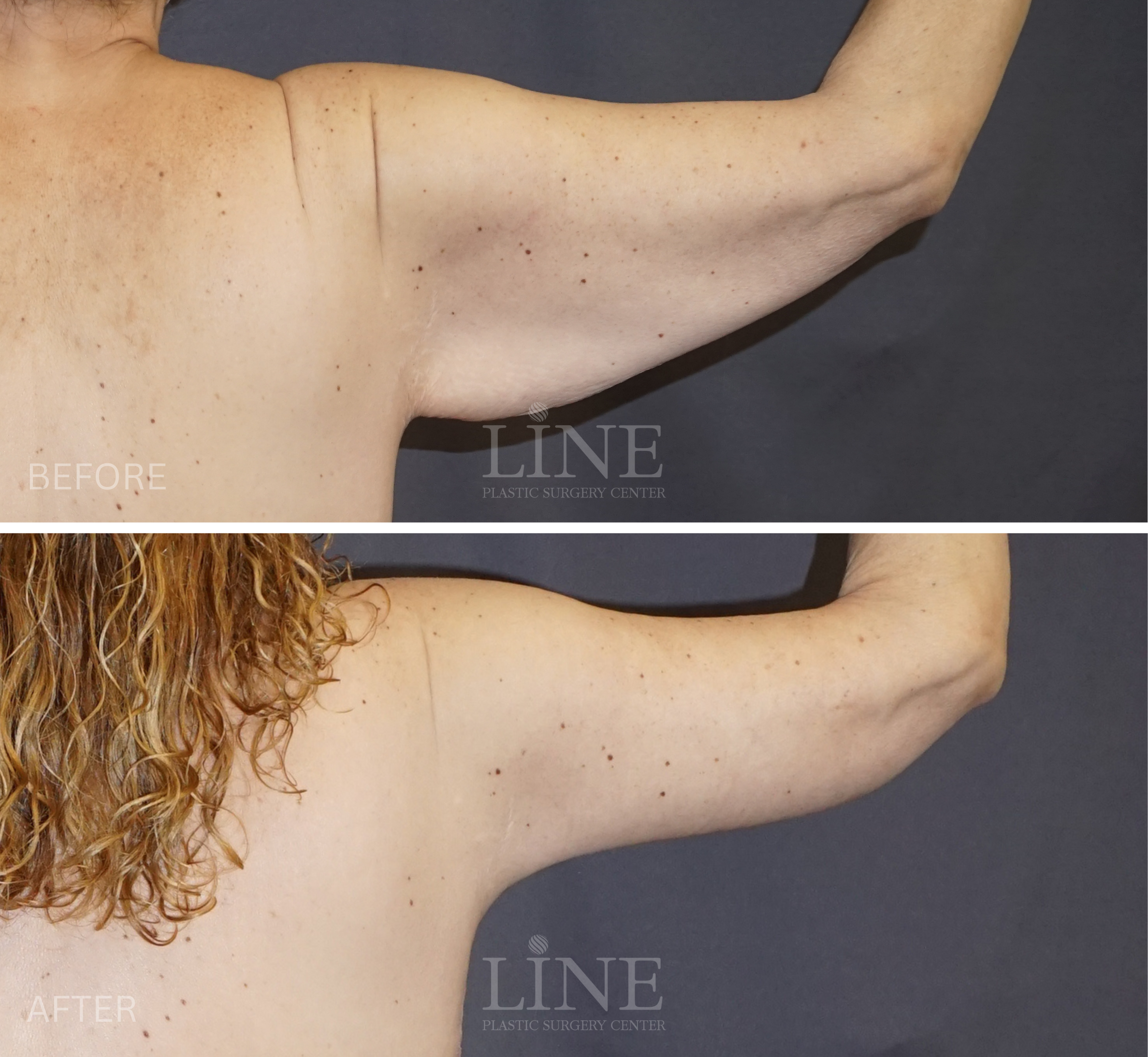 ARM LIFT (6)
