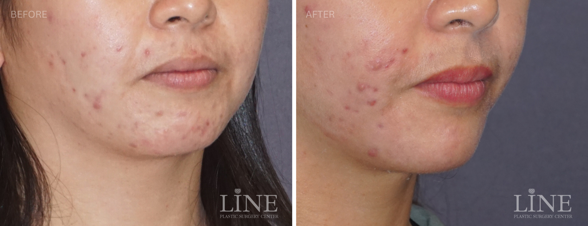 CHIN IMPLANT (10)