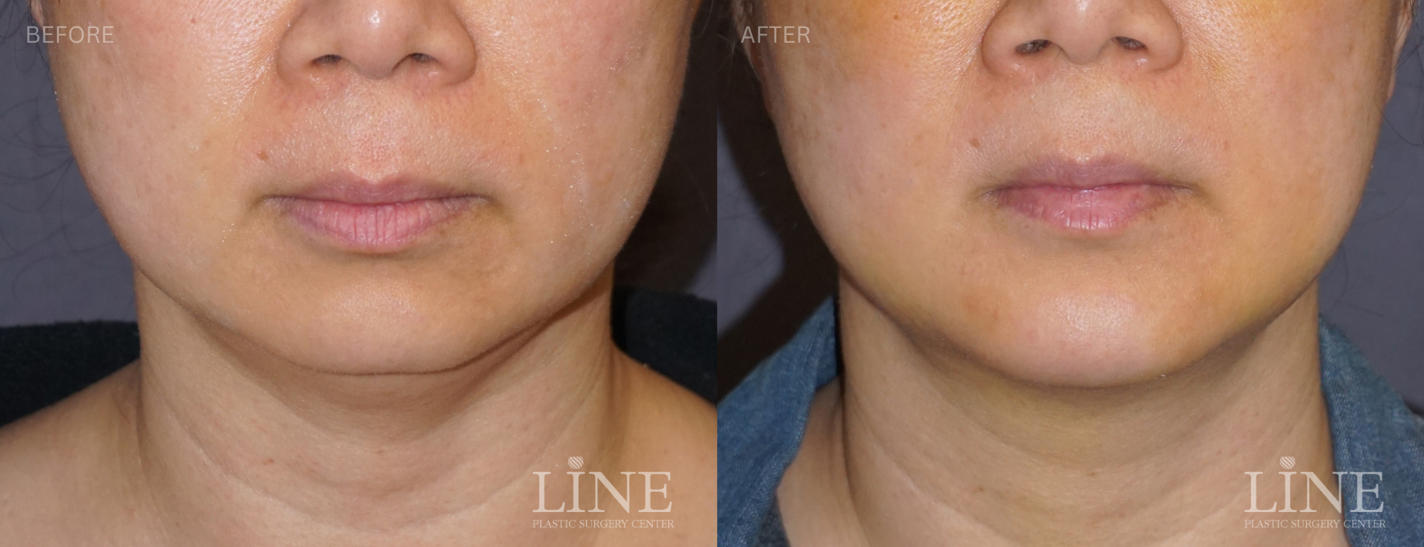 CHIN IMPLANT (4)