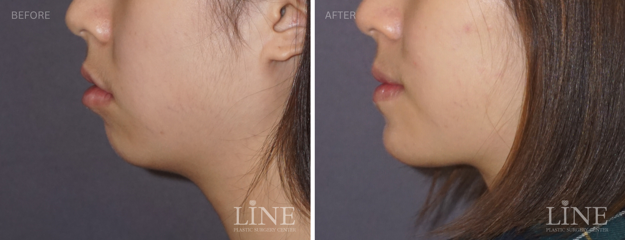 CHIN IMPLANT (7)