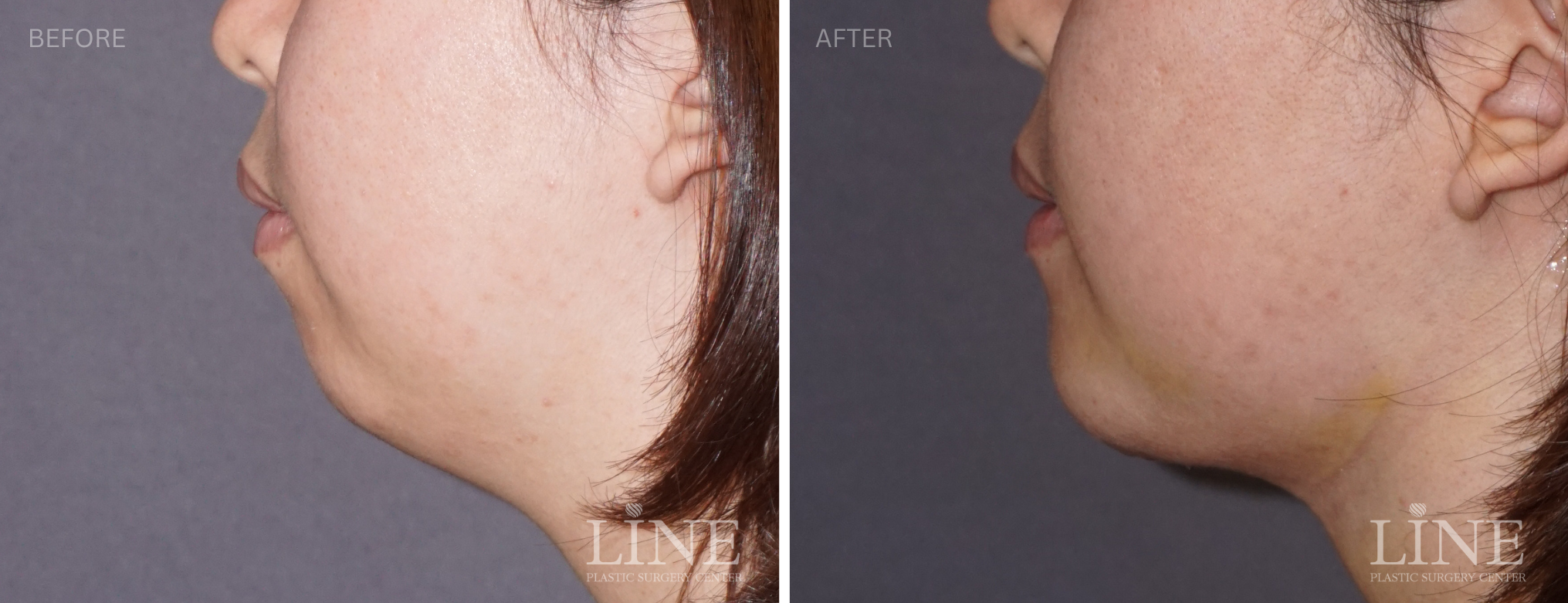 CHIN IMPLANT (9)