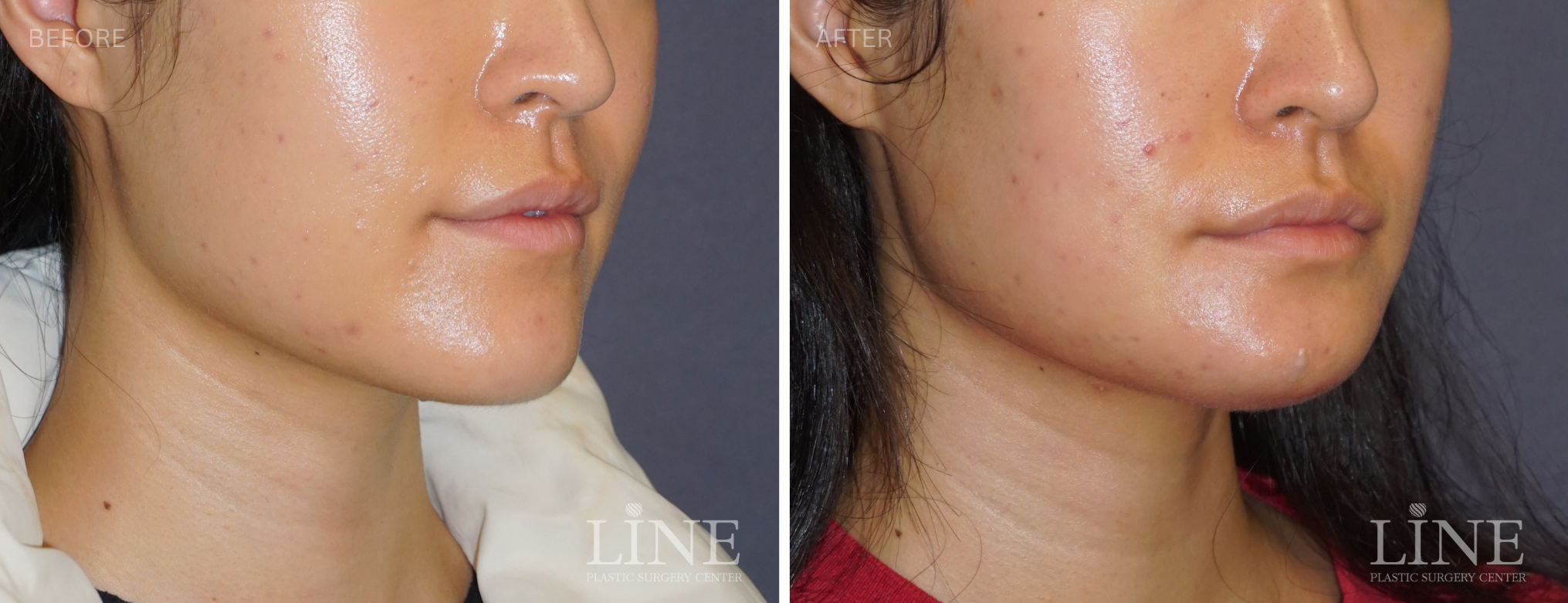 CHIN REDUCTION (2)