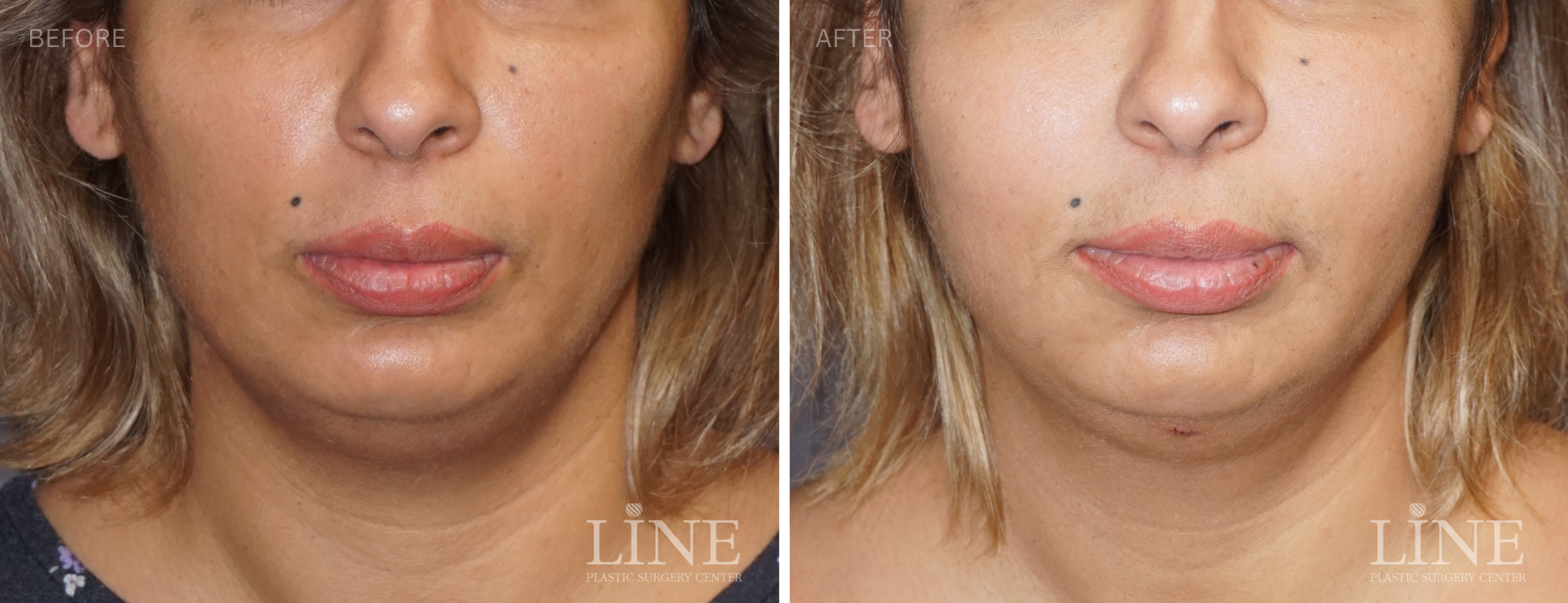 FAT GRAFT (4)