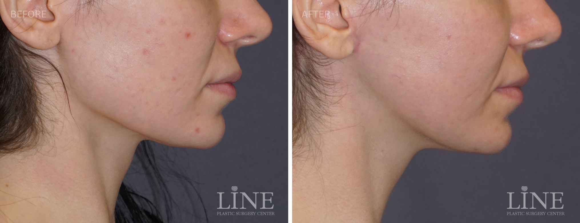 JAWLINE SHAVING (11)