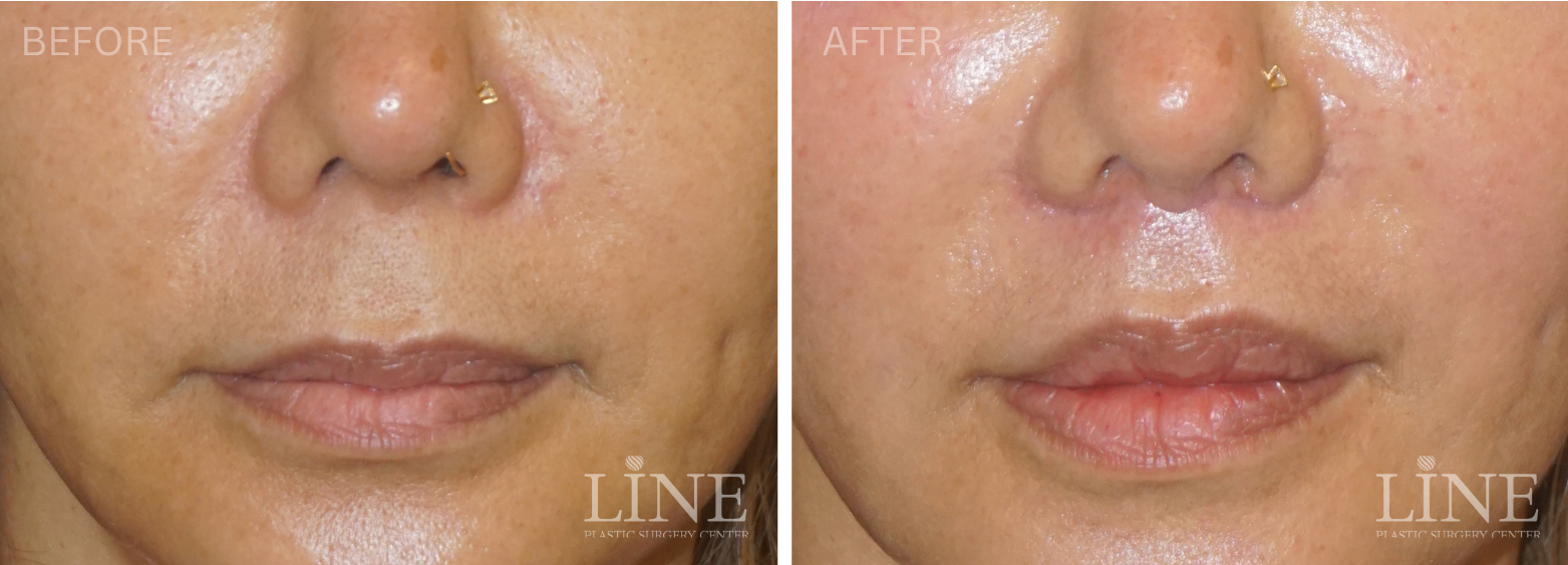 LIP LIFT (10)