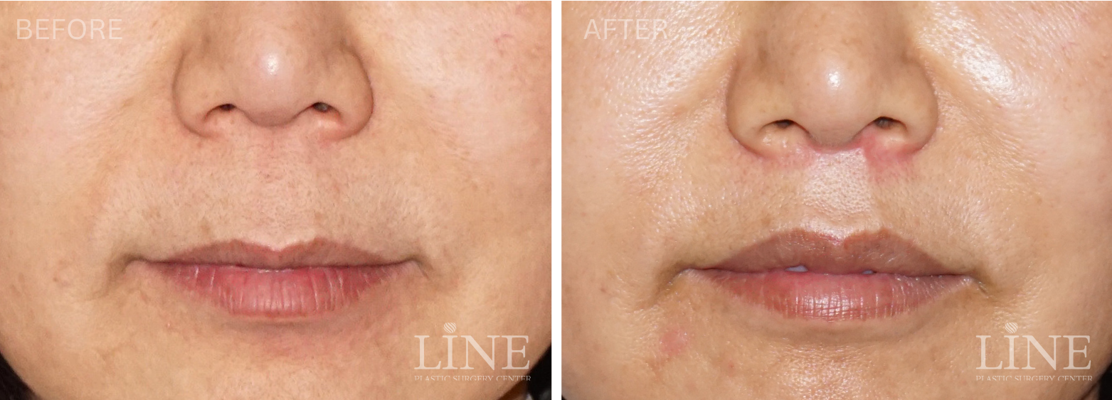 LIP LIFT (11)