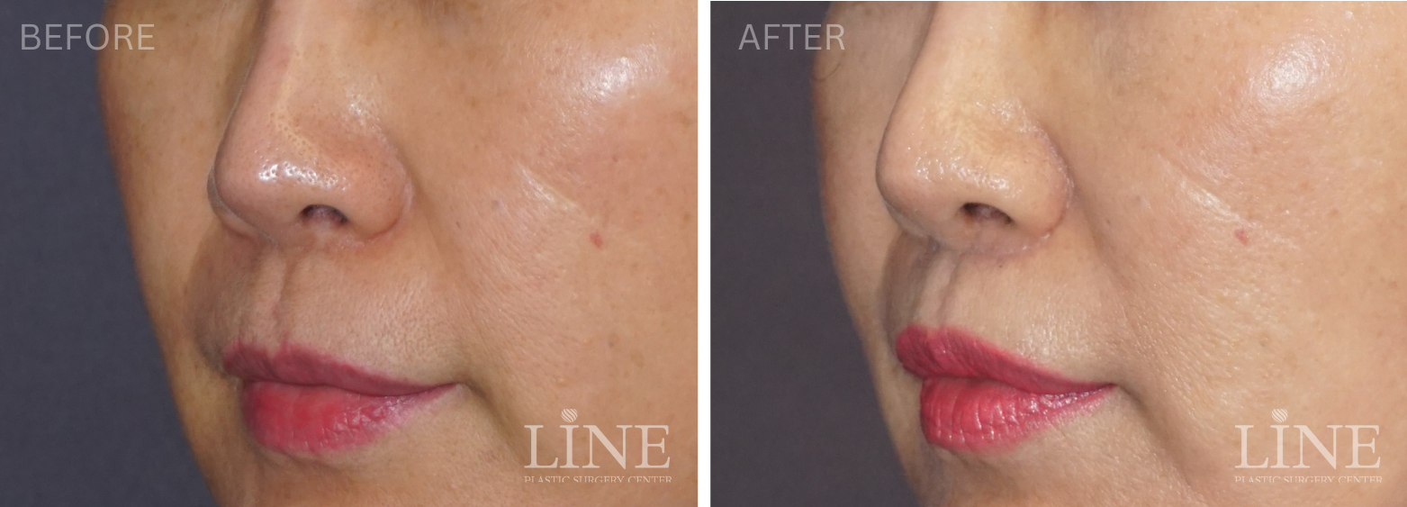 LIP LIFT (4)