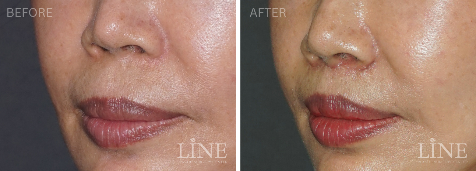 LIP LIFT (7)