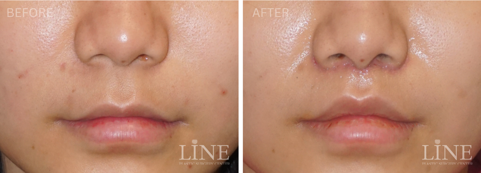 LIP LIFT (8)