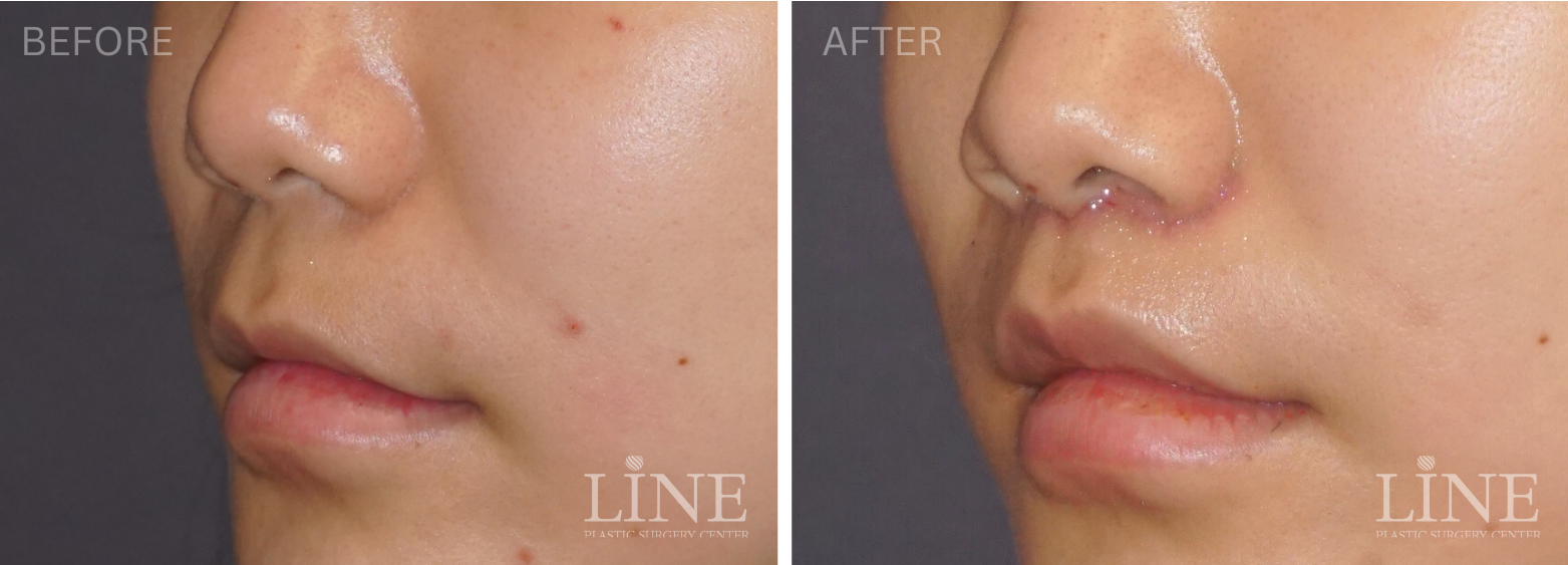 LIP LIFT (9)