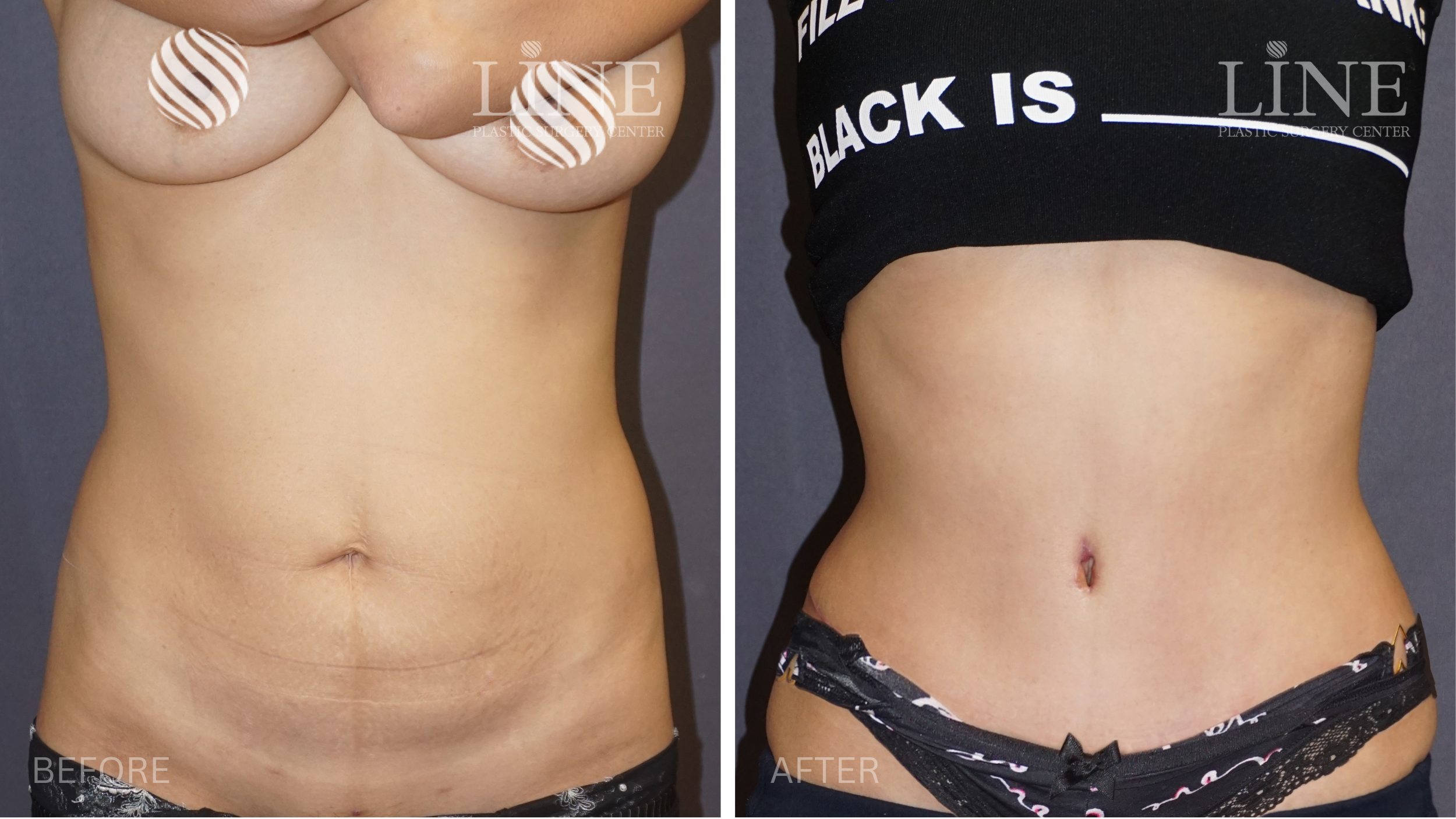 TUMMY TUCK (8)