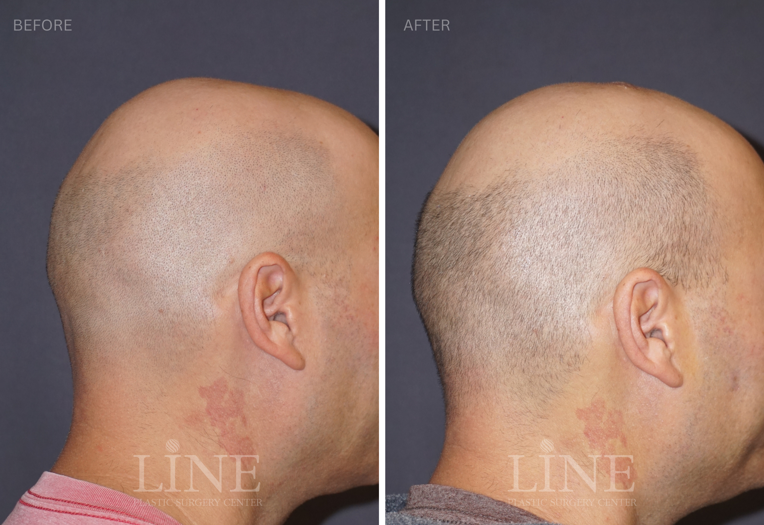 CROWN SKULL RESHAPING (2)