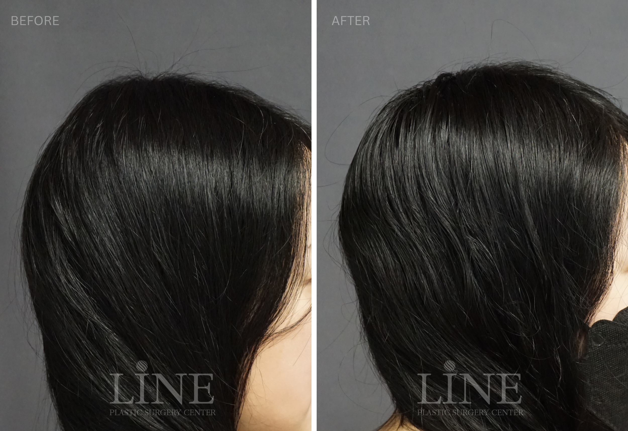 CROWN SKULL RESHAPING (3)