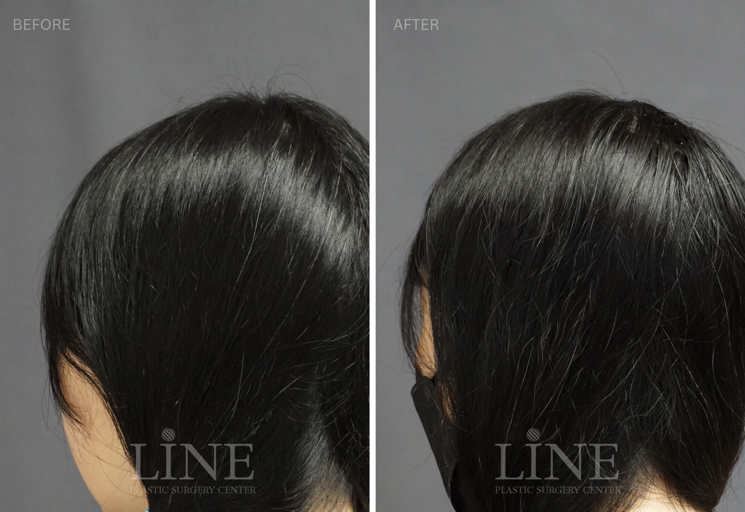 CROWN SKULL RESHAPING (4)
