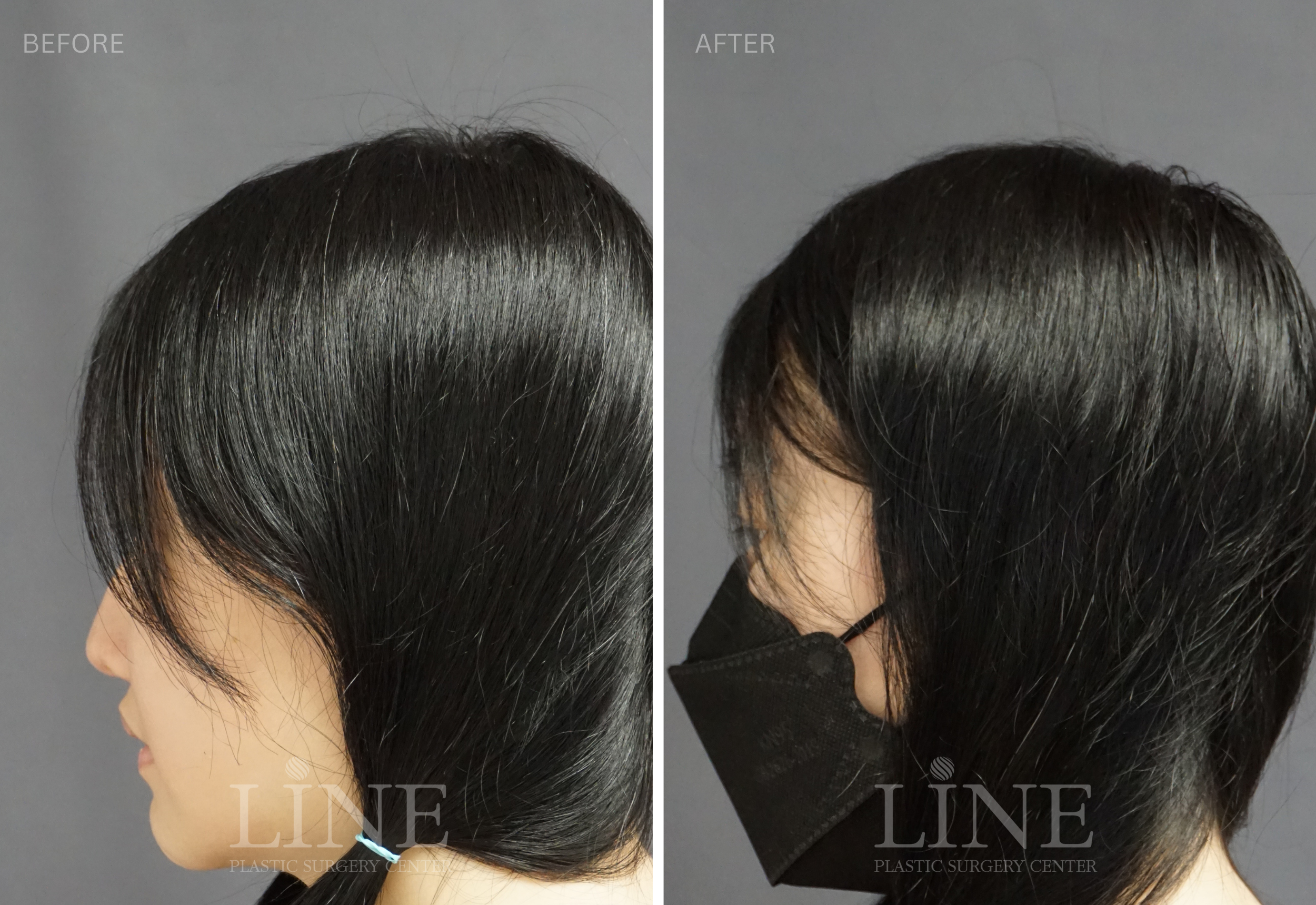 CROWN SKULL RESHAPING (5)