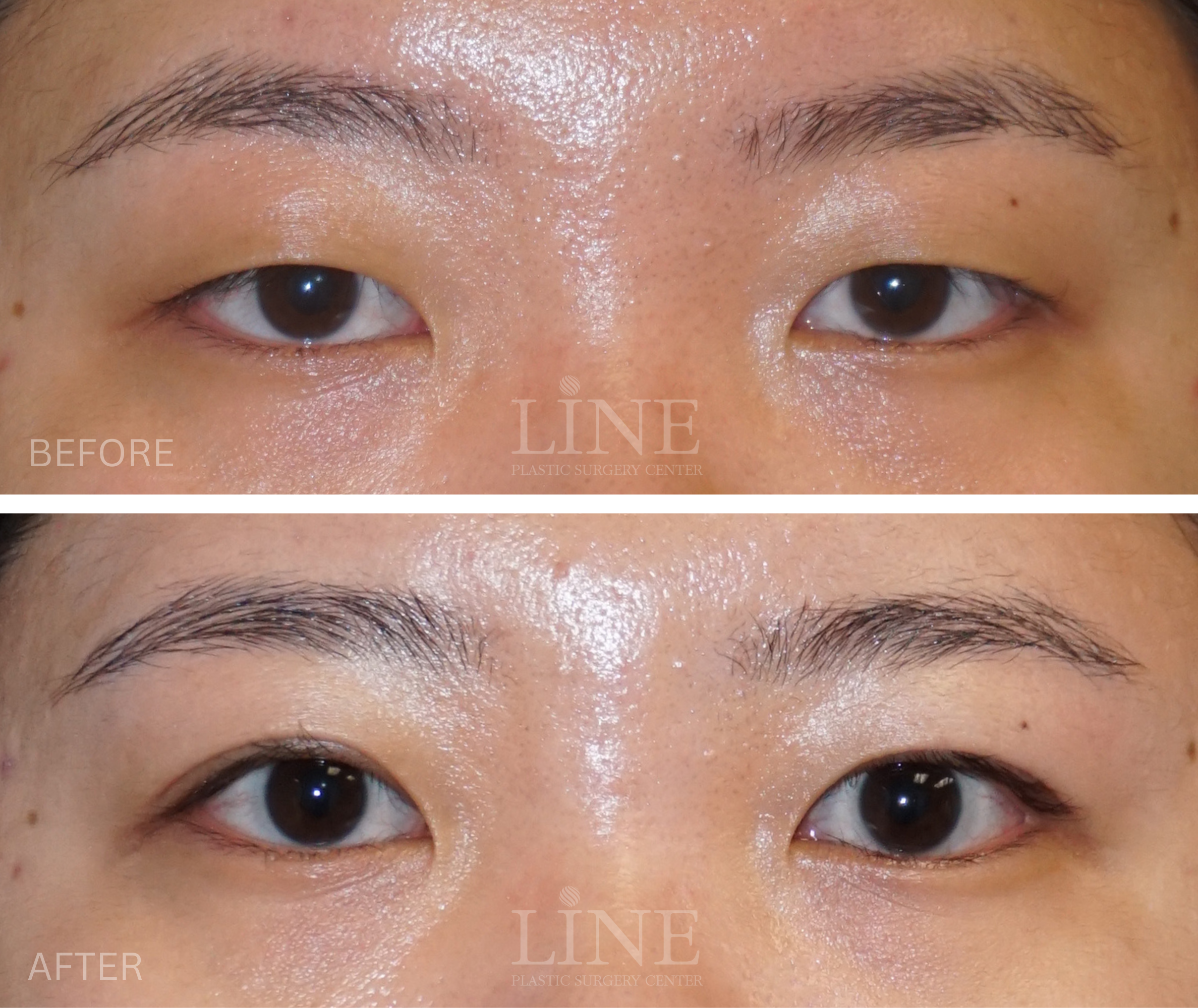 EYE_DOUBLE EYELID (10)