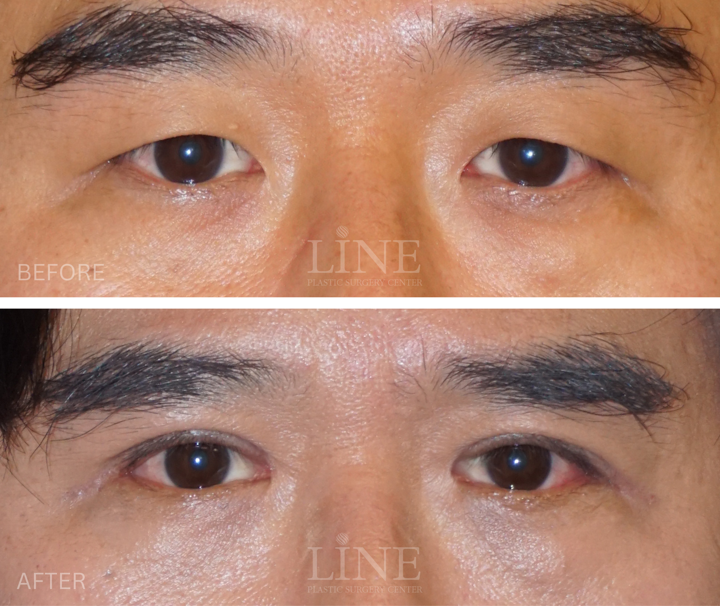 EYE_DOUBLE EYELID (11)