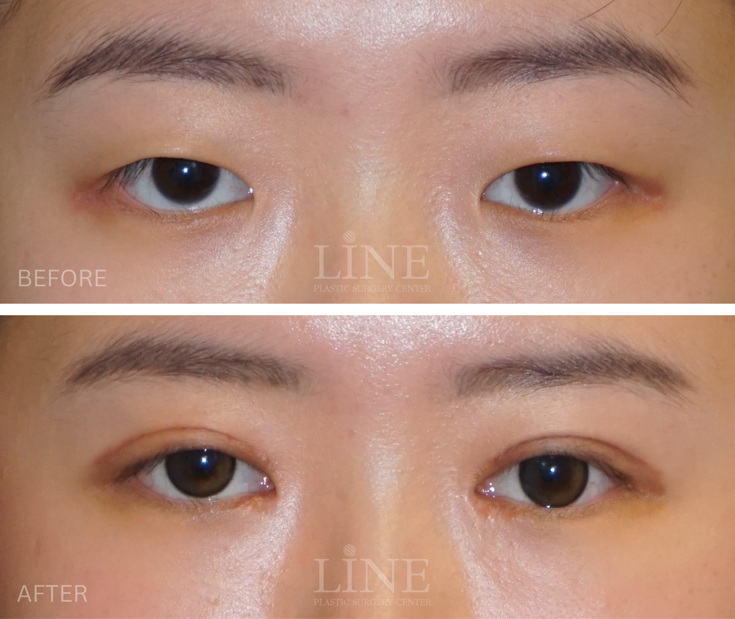 EYE_DOUBLE EYELID (12)