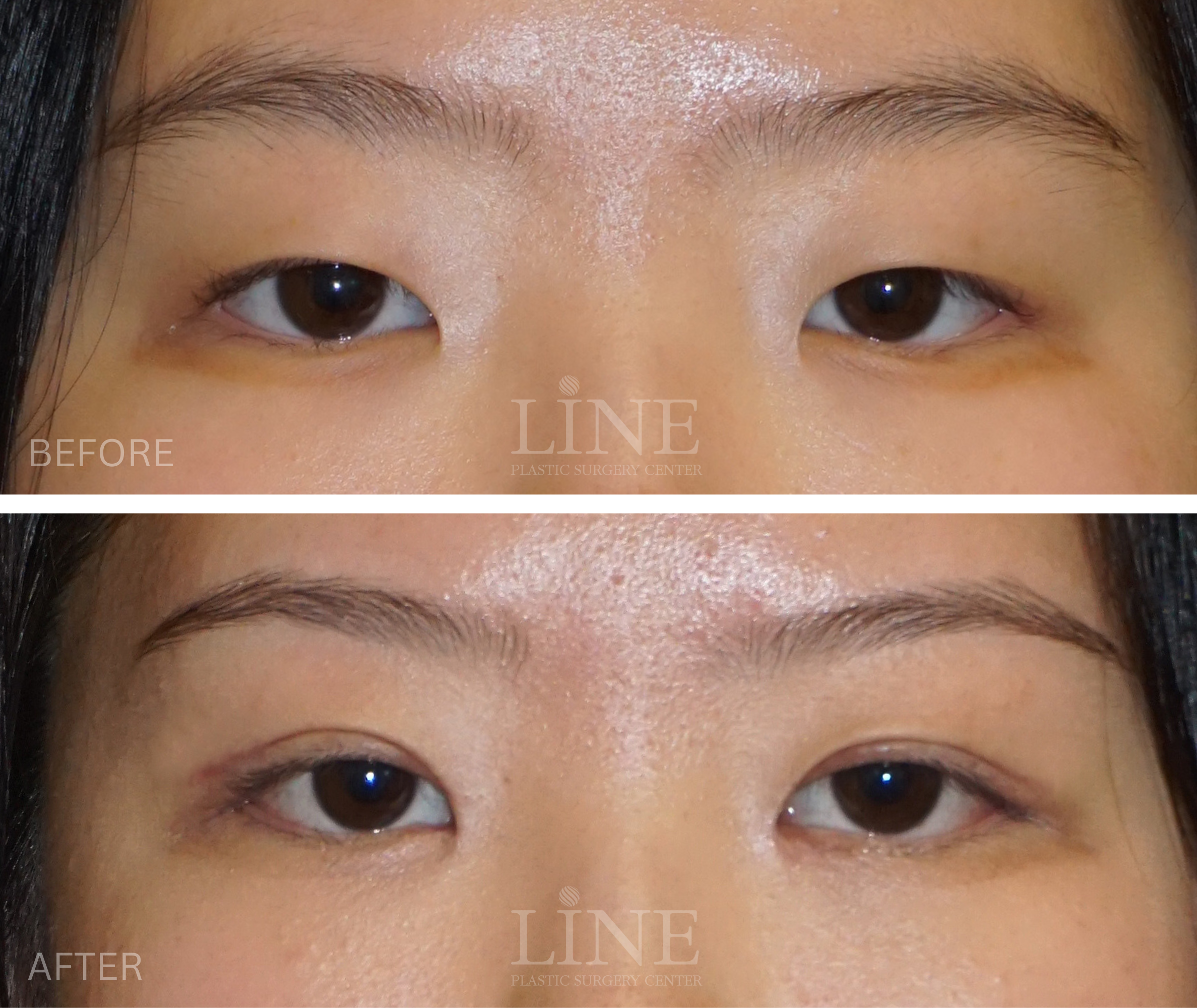 EYE_DOUBLE EYELID (13)