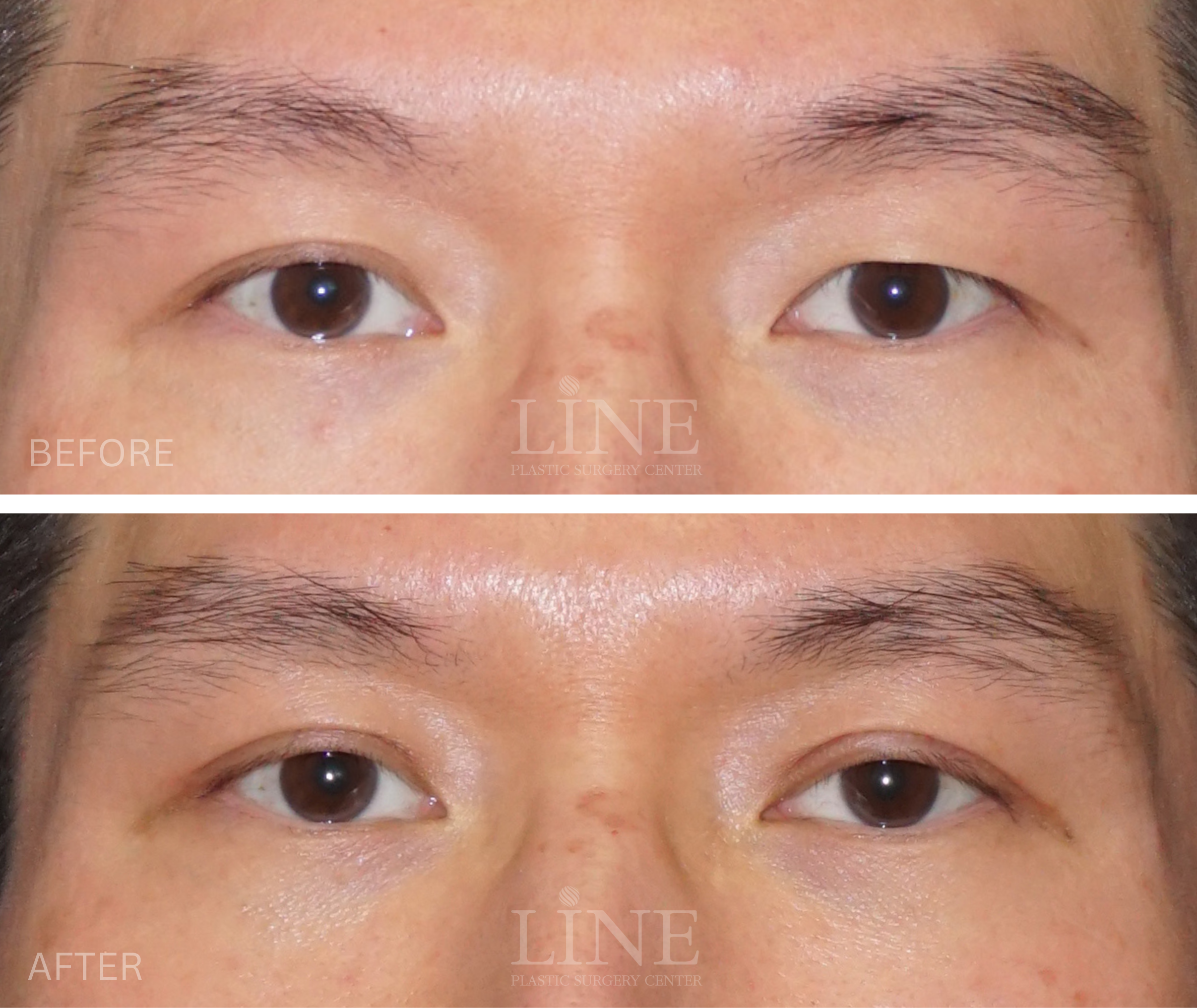 EYE_DOUBLE EYELID (15)