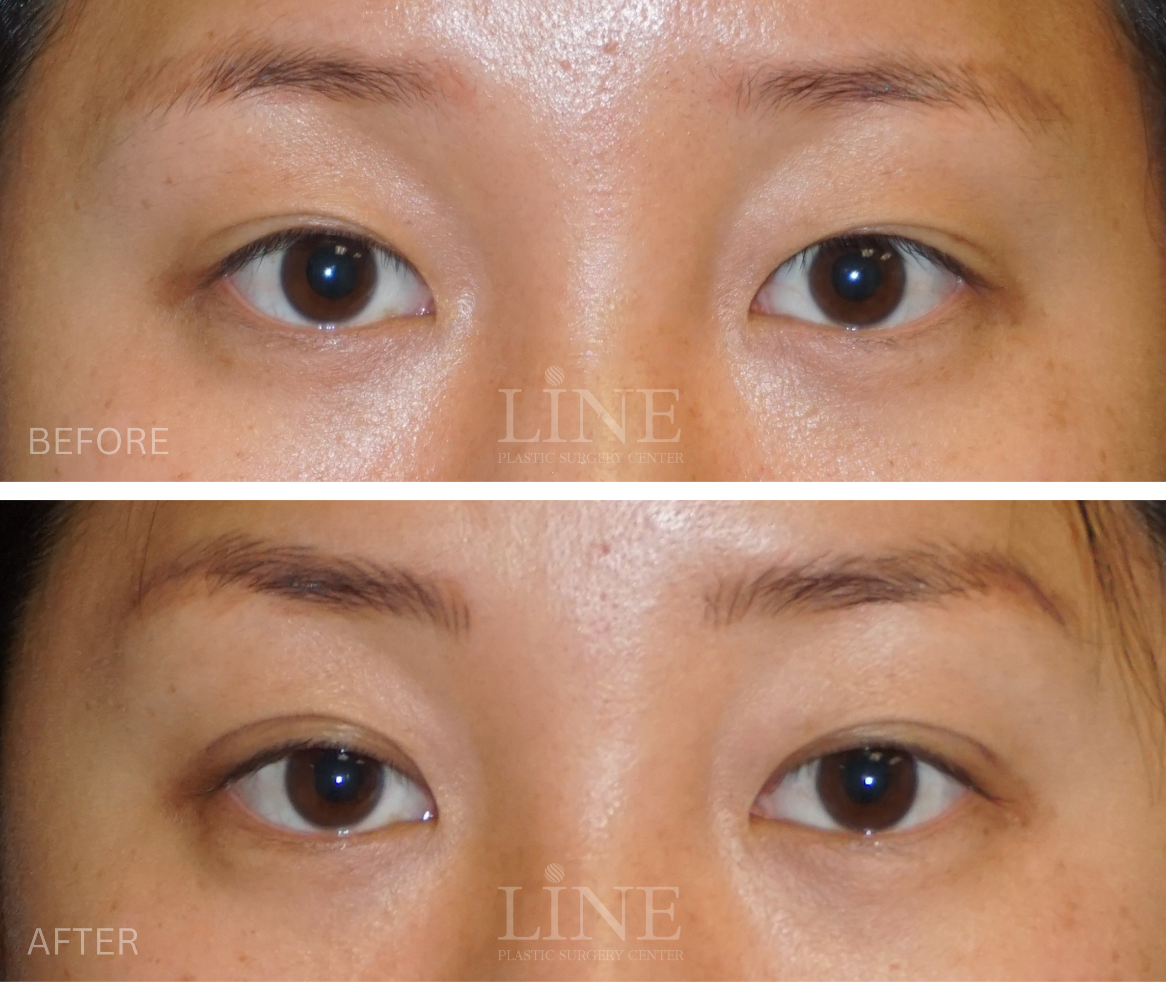 EYE_DOUBLE EYELID (16)
