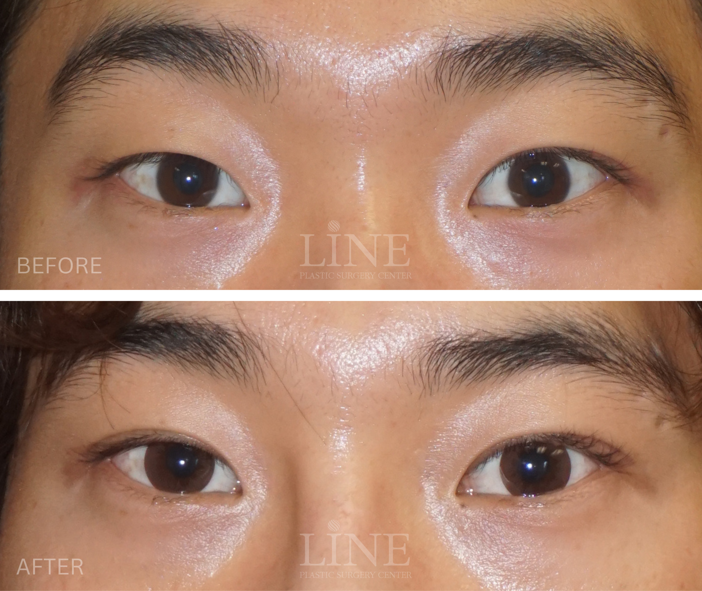 EYE_DOUBLE EYELID (2)