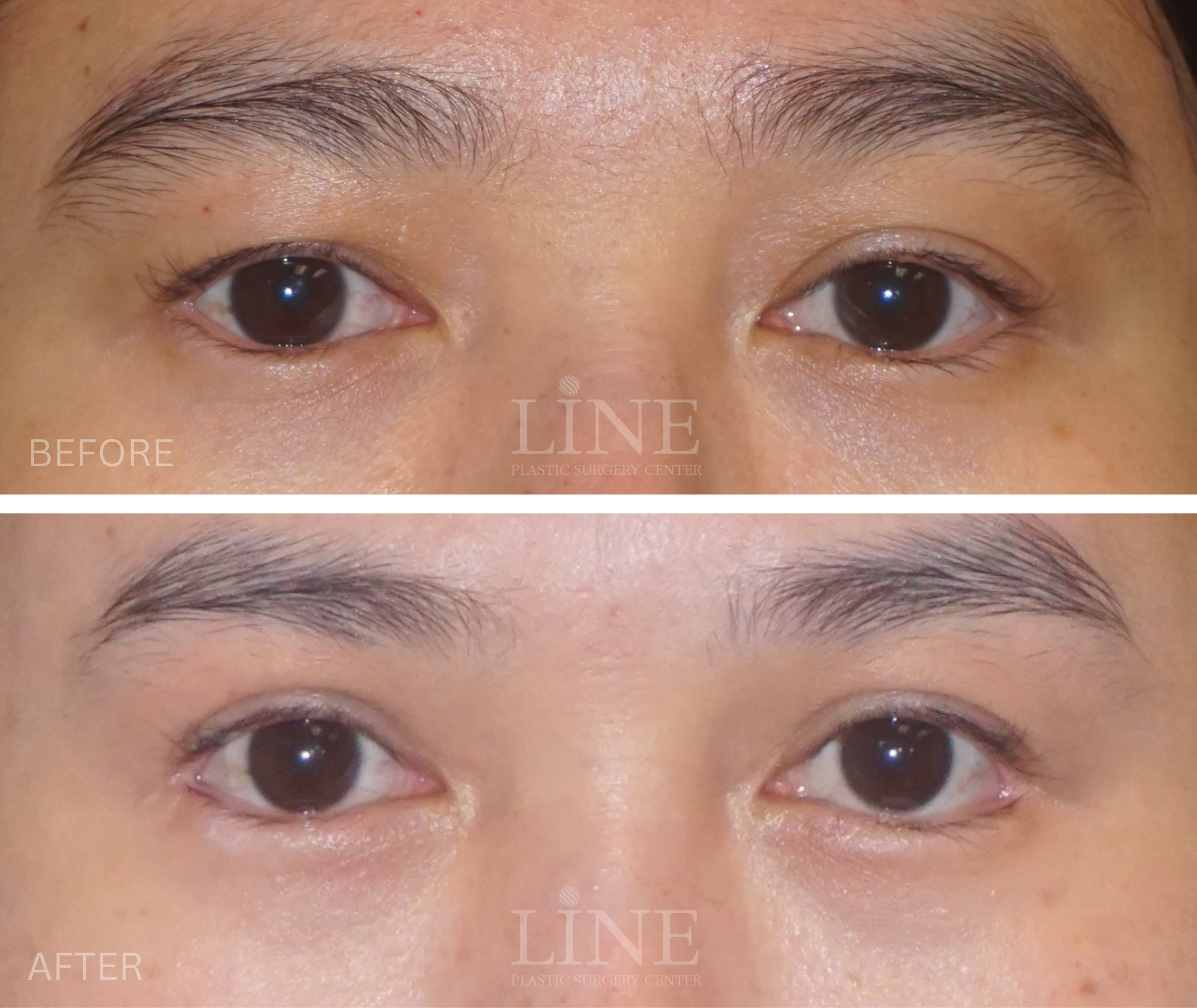 EYE_DOUBLE EYELID (3)