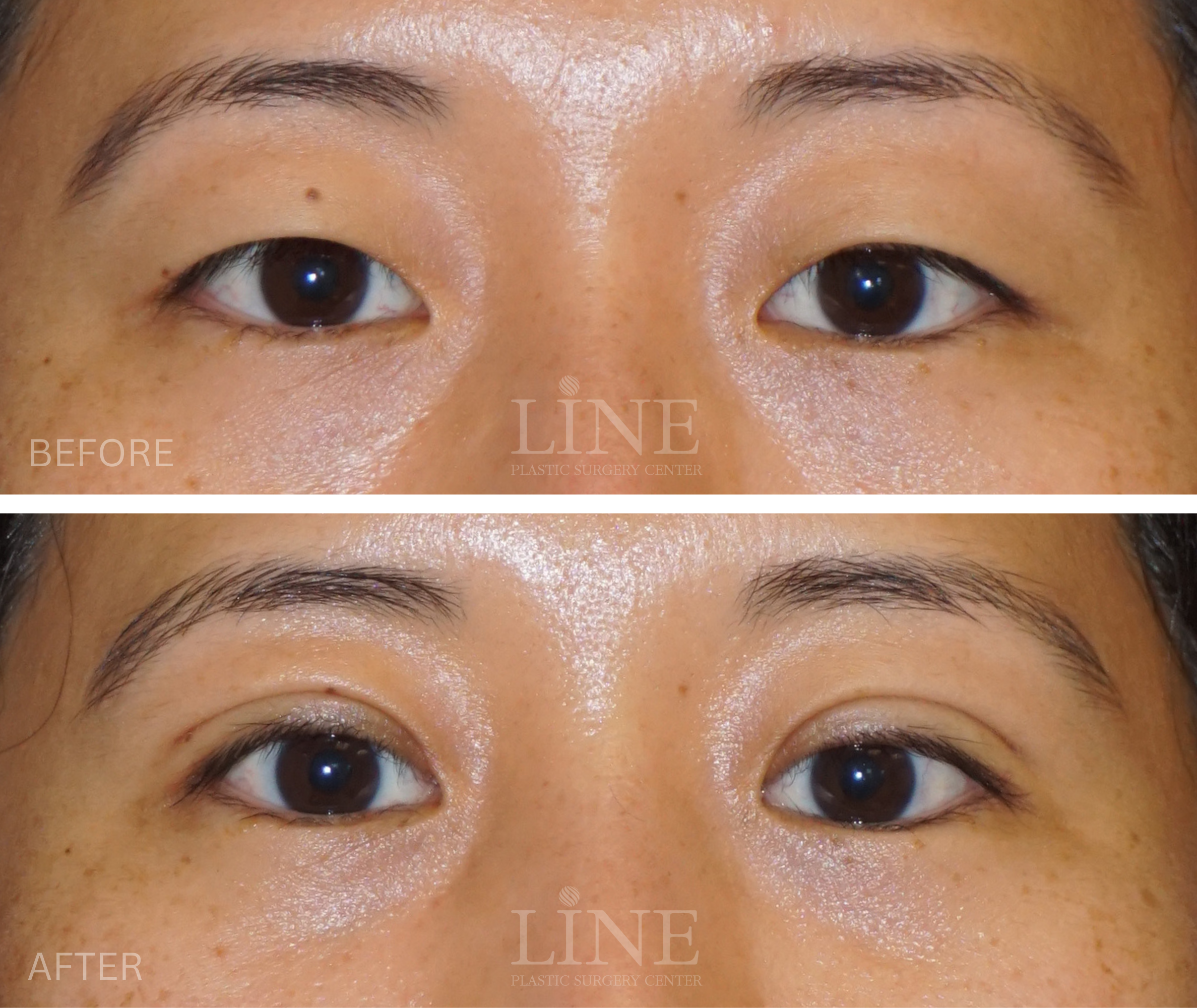 EYE_DOUBLE EYELID (4)