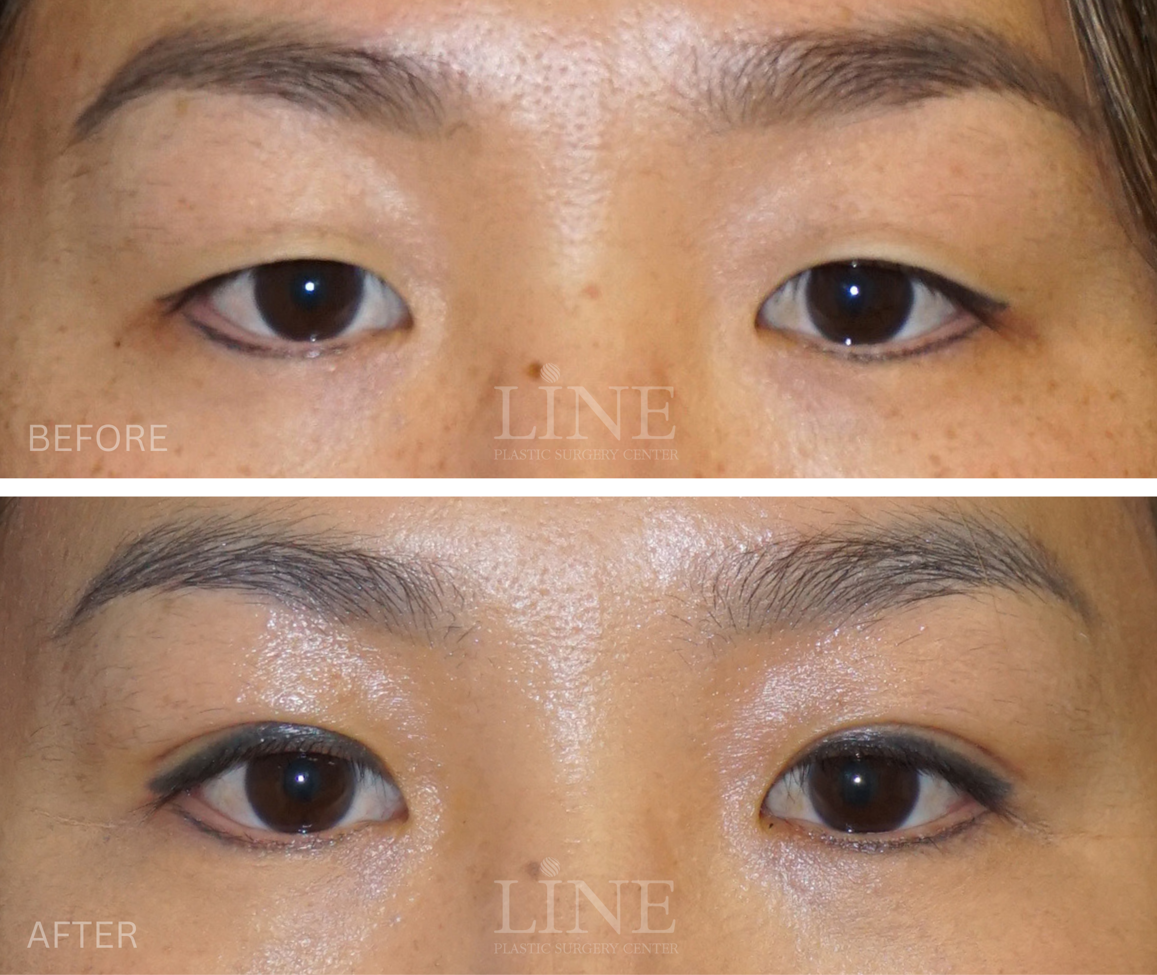 EYE_DOUBLE EYELID (6)