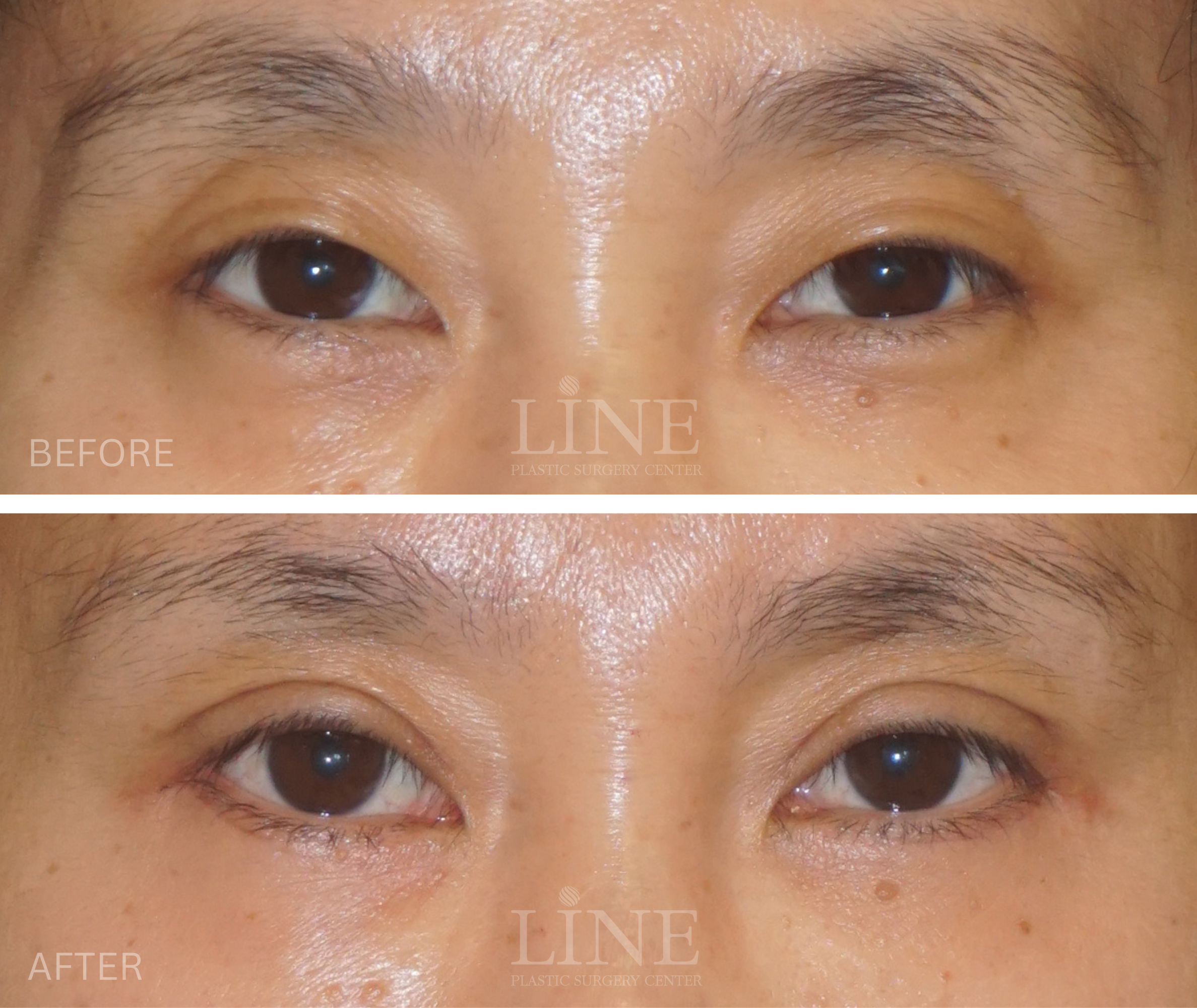 EYE_DOUBLE EYELID (8)
