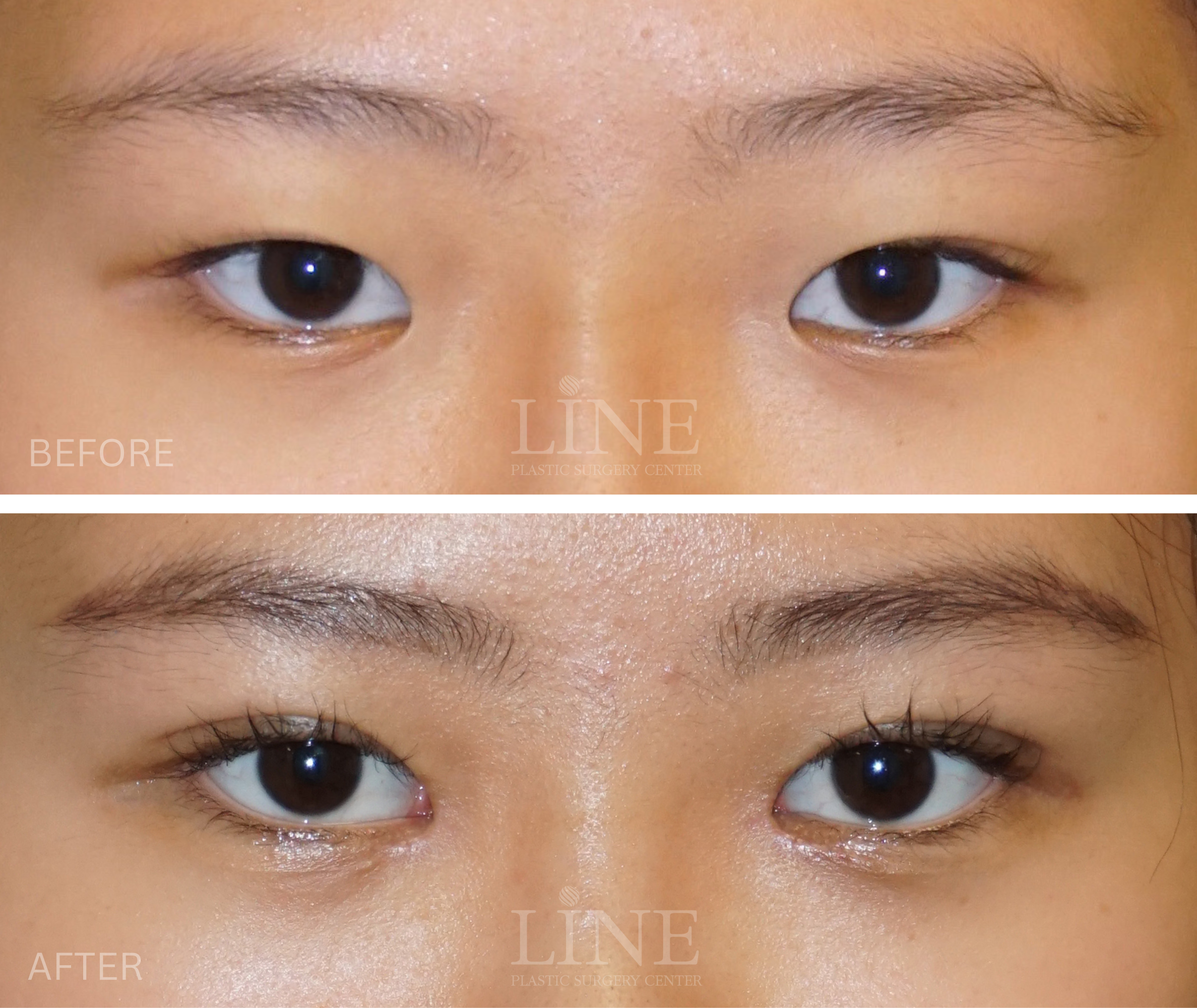 EYE_DOUBLE EYELID (9)