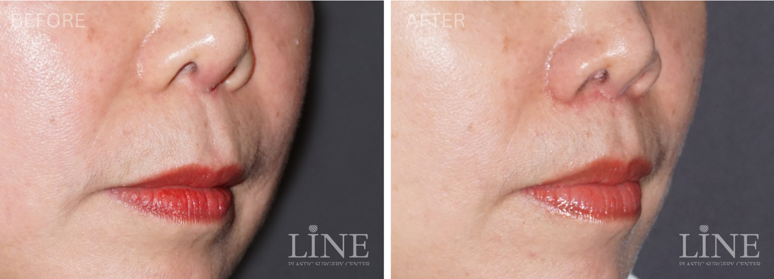LIP LIFT (13)