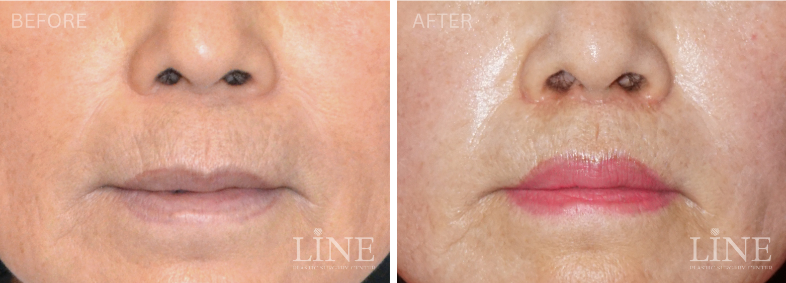 LIP LIFT (14)
