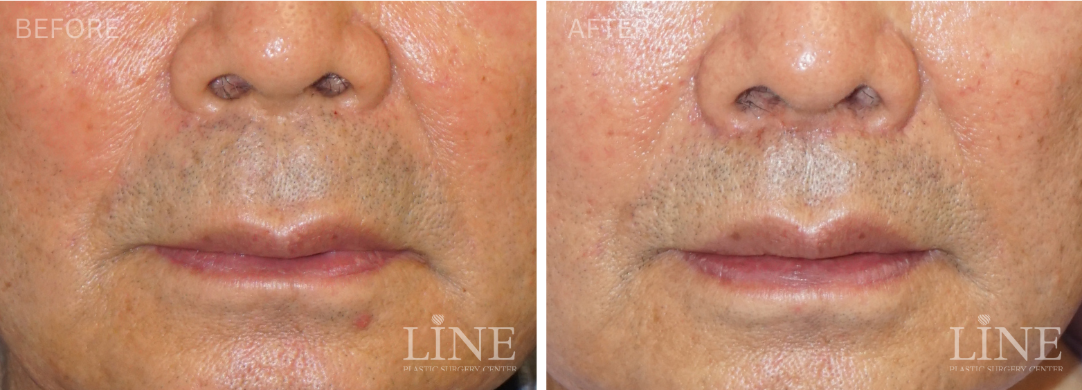 LIP LIFT (15)