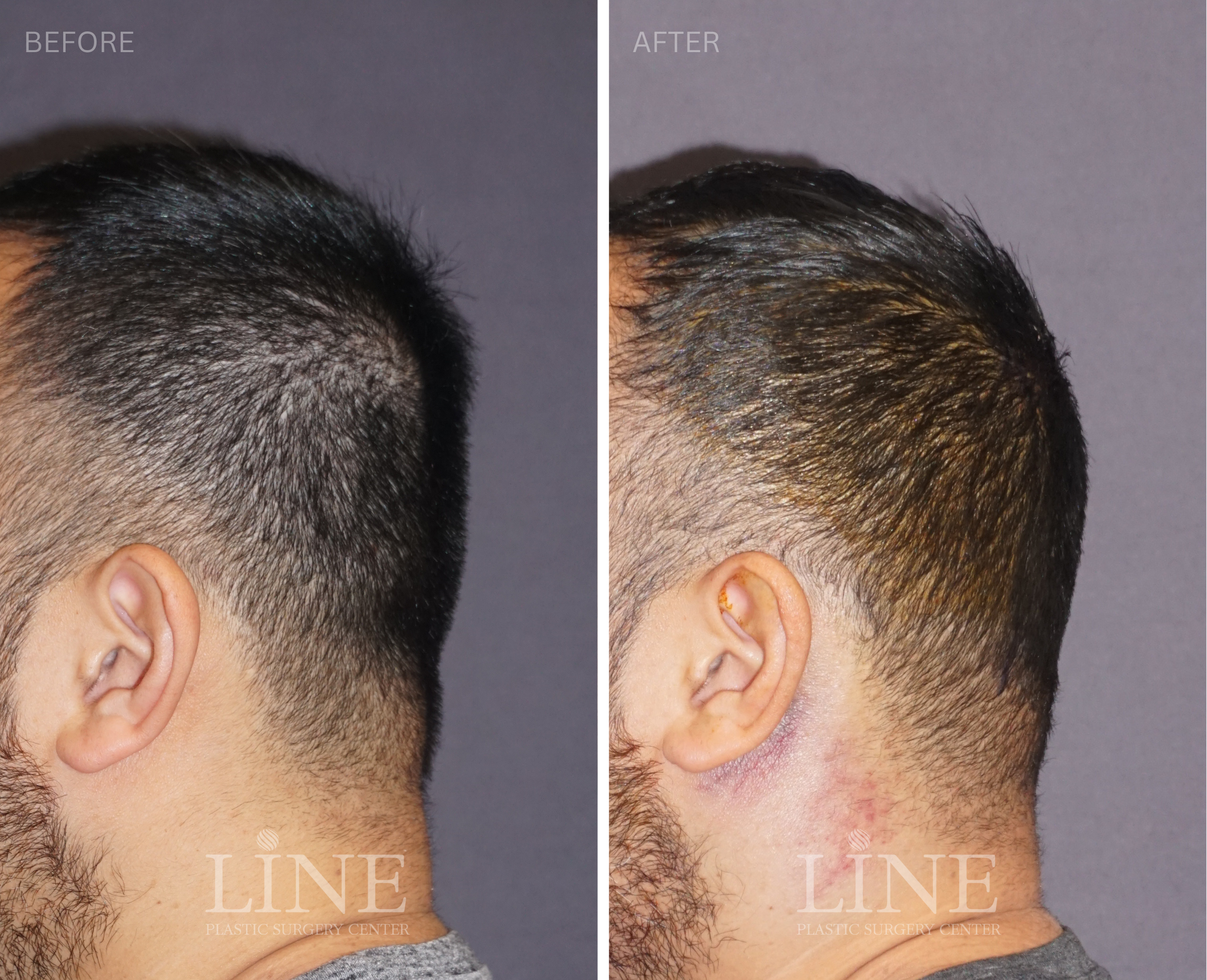 OCCIPITAL SKULL RESHAPING (11)
