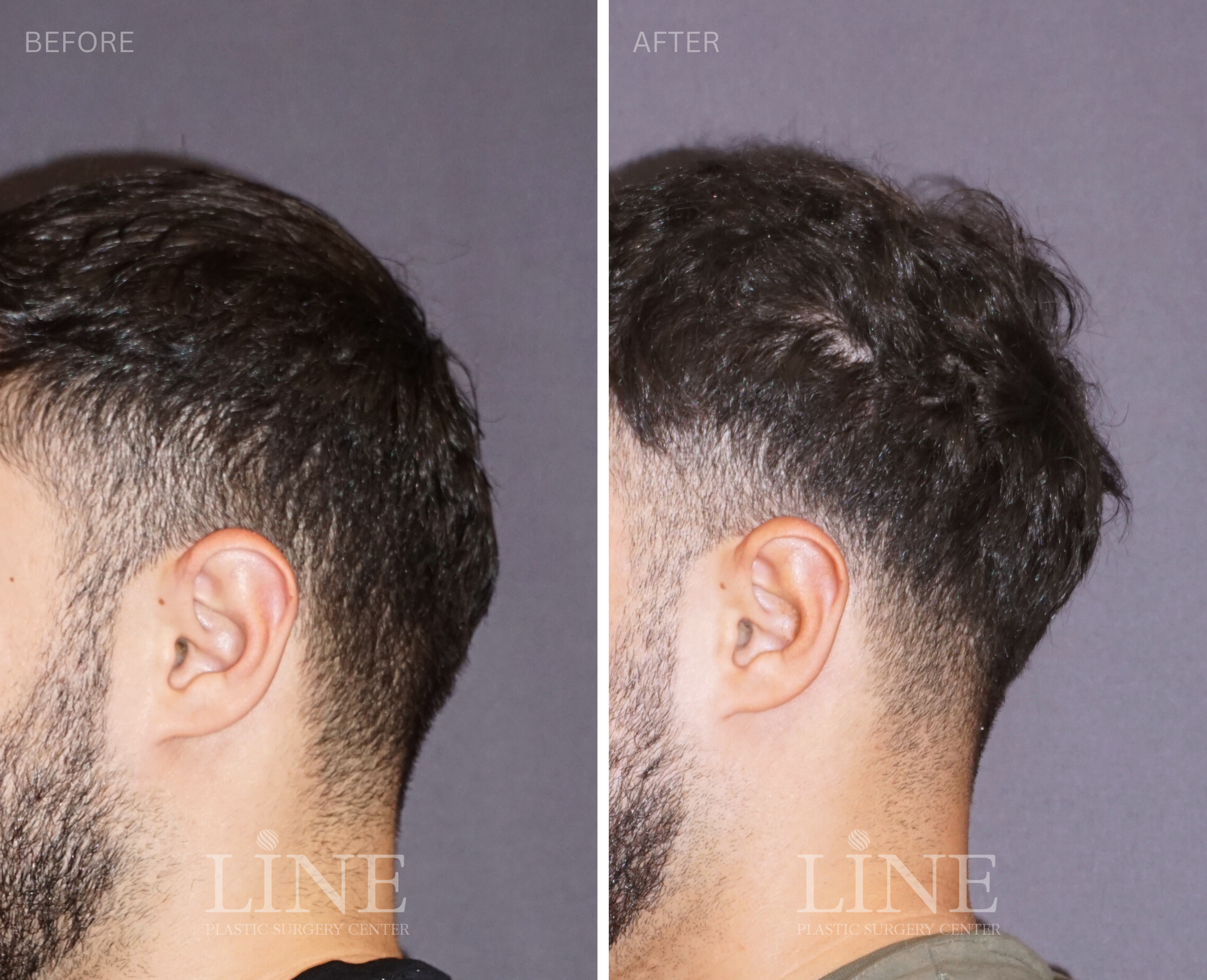 OCCIPITAL SKULL RESHAPING (12)