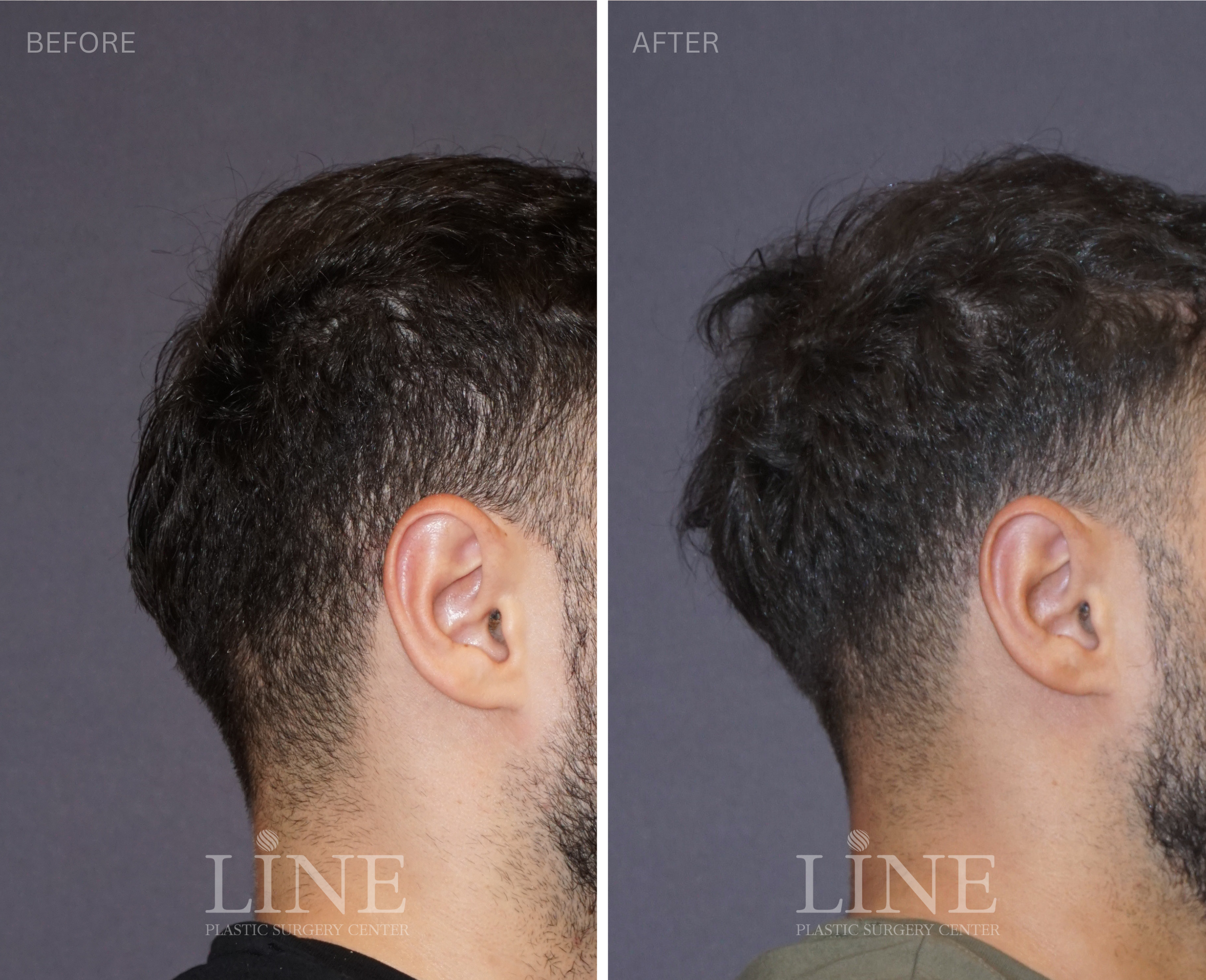 OCCIPITAL SKULL RESHAPING (13)