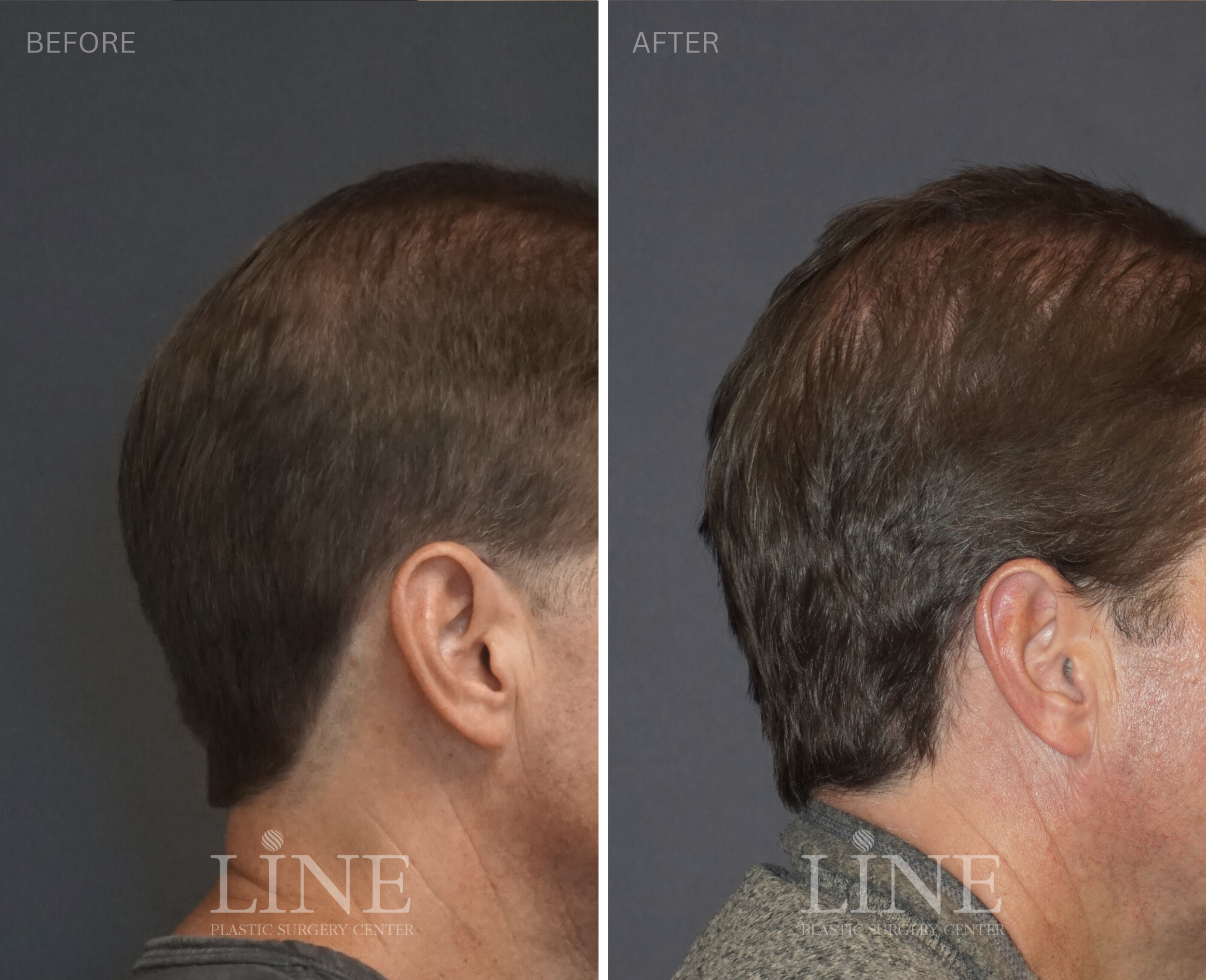 OCCIPITAL SKULL RESHAPING (14)