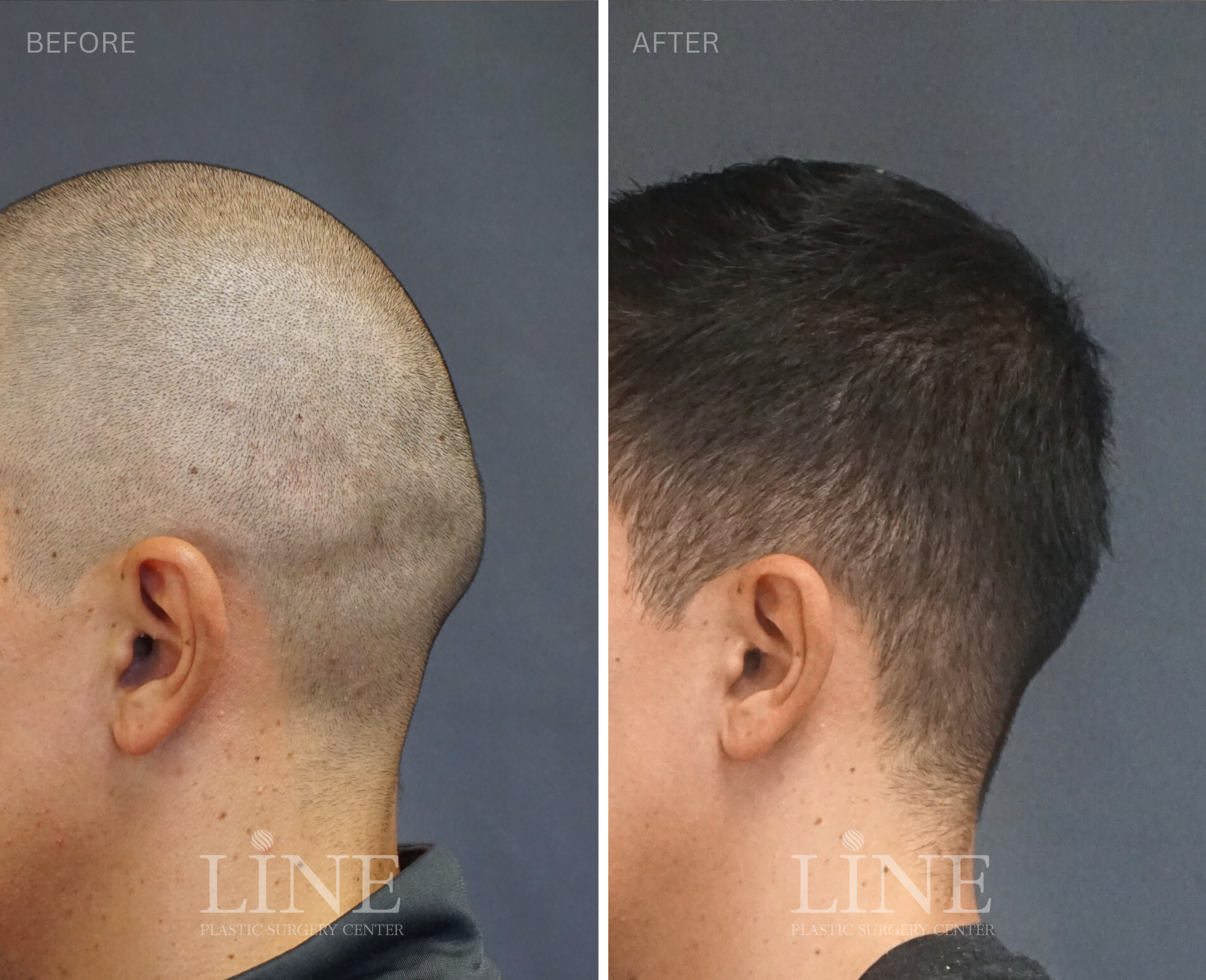 OCCIPITAL SKULL RESHAPING (15)