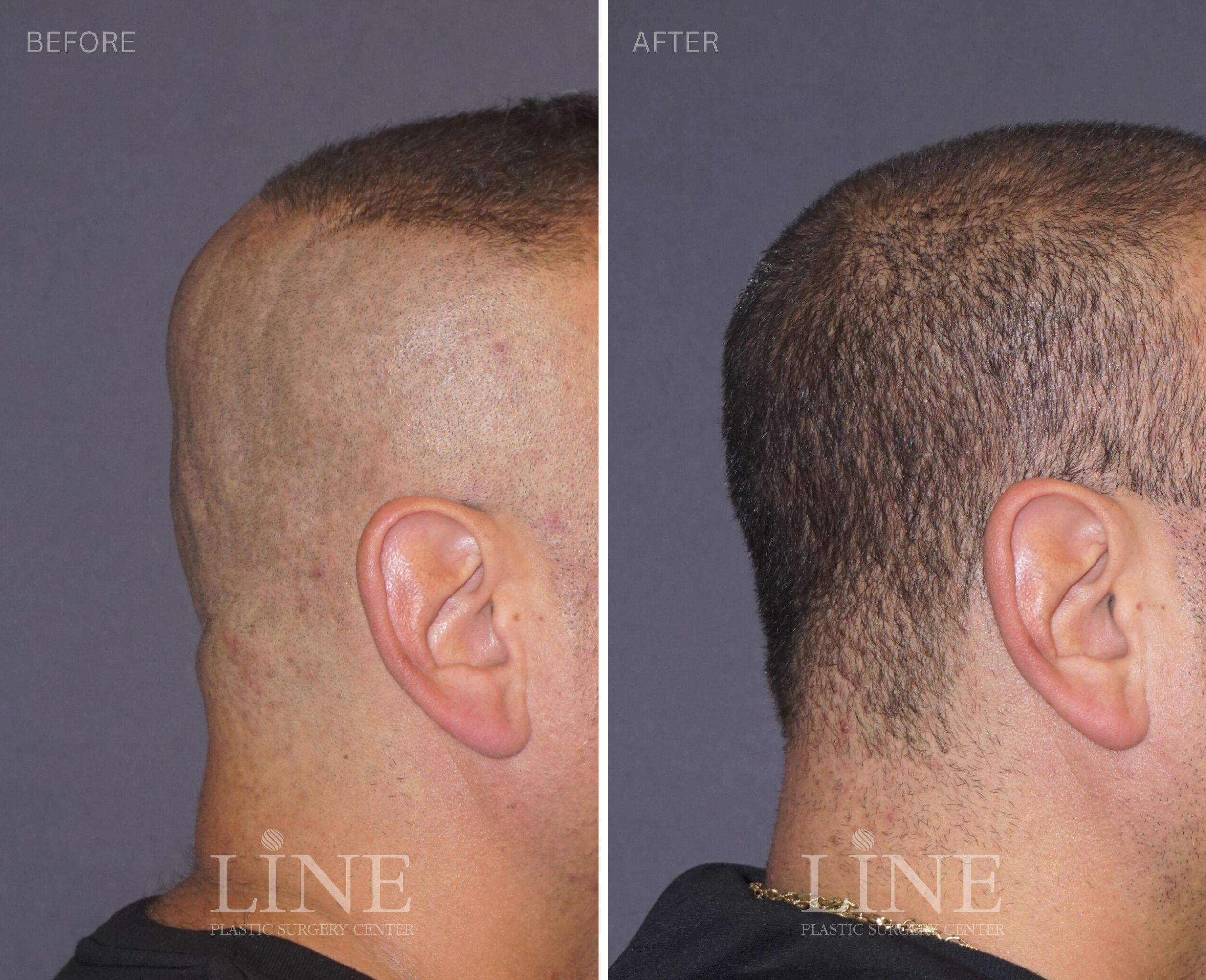 OCCIPITAL SKULL RESHAPING (17)