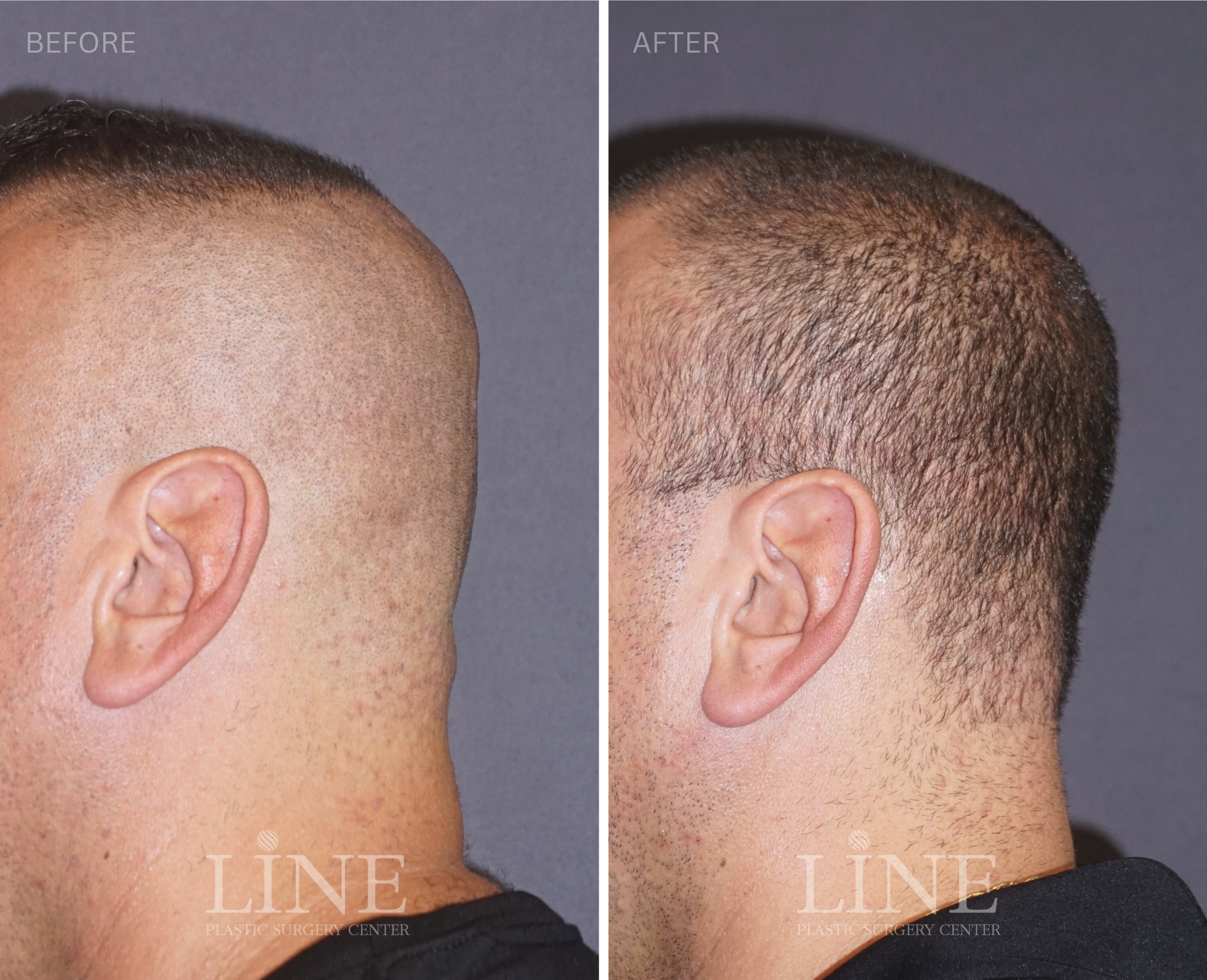 OCCIPITAL SKULL RESHAPING (18)