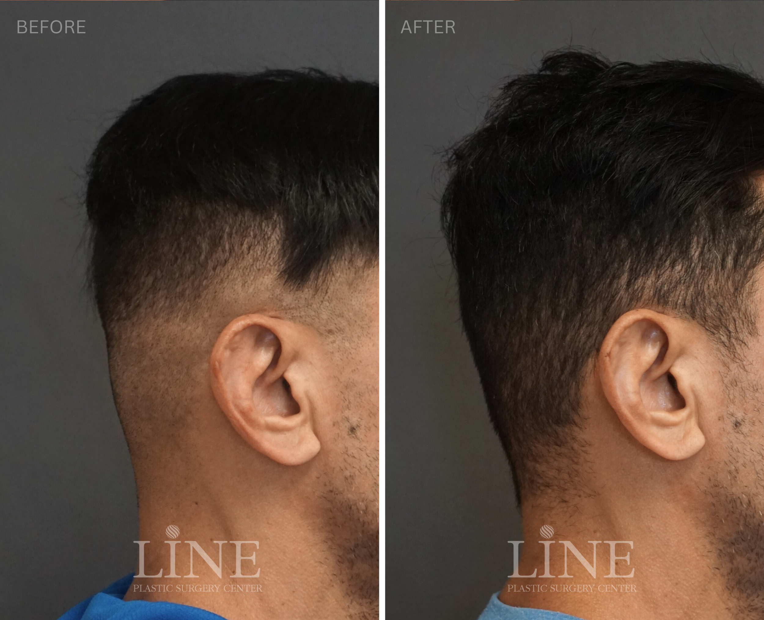 OCCIPITAL SKULL RESHAPING (19)