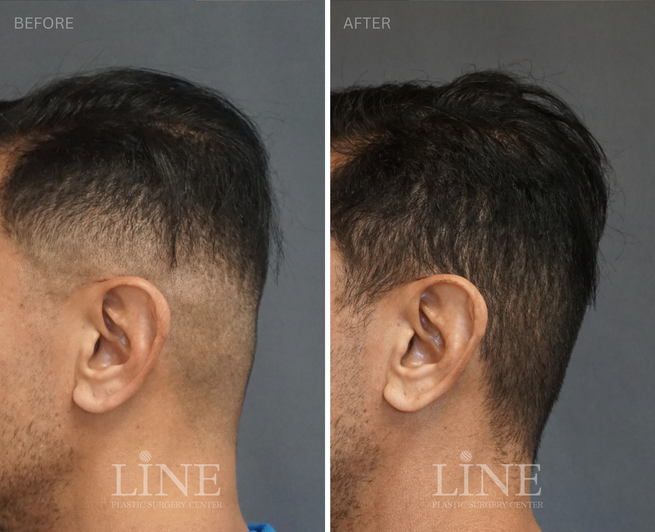 OCCIPITAL SKULL RESHAPING (20)