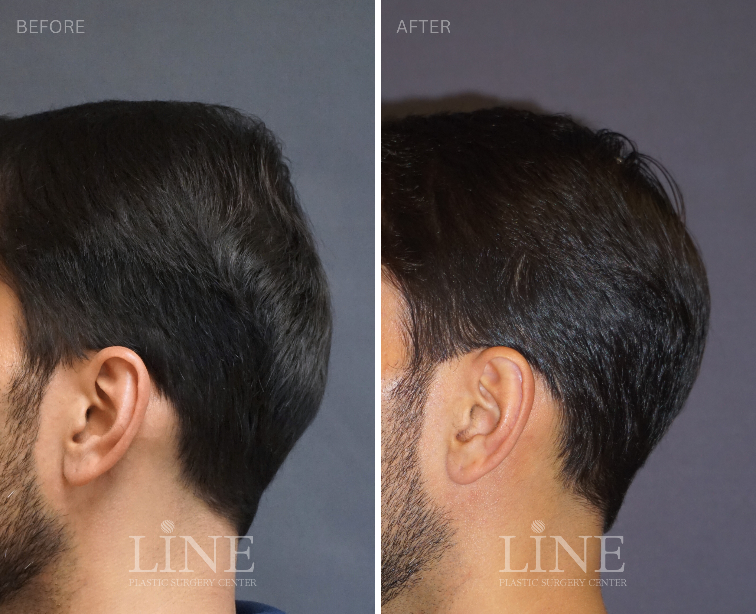 OCCIPITAL SKULL RESHAPING (24)