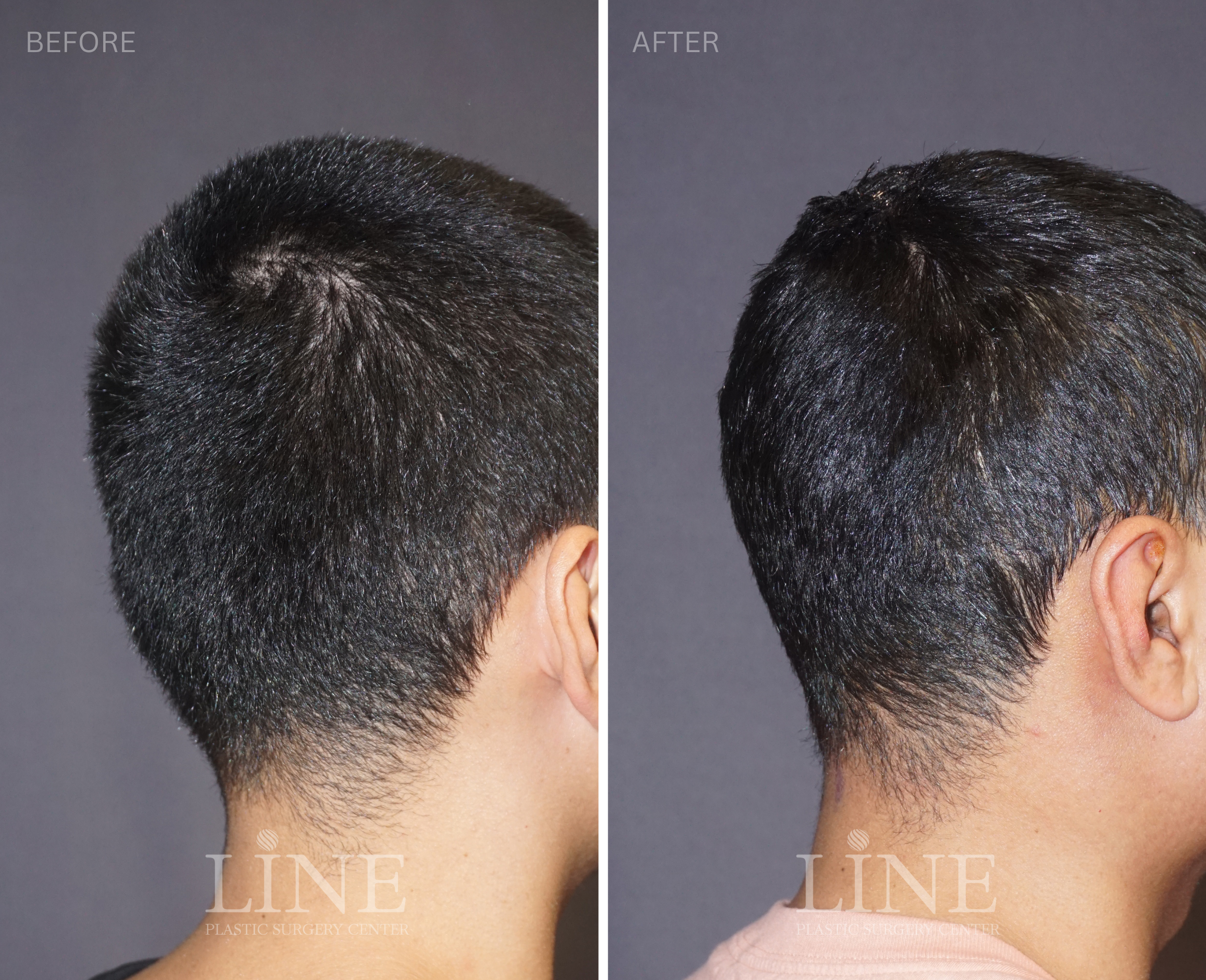 OCCIPITAL SKULL RESHAPING (25)