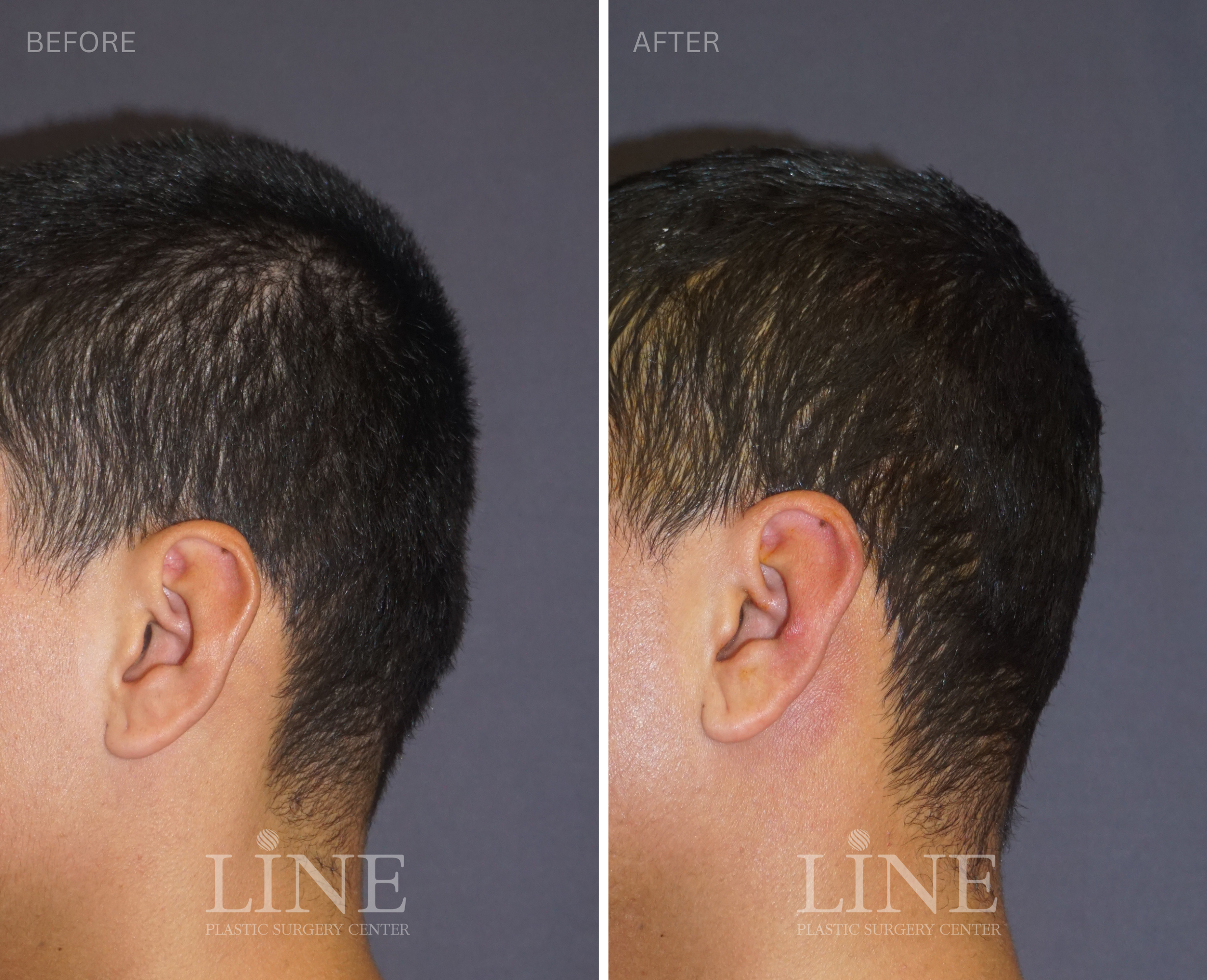 OCCIPITAL SKULL RESHAPING (26)